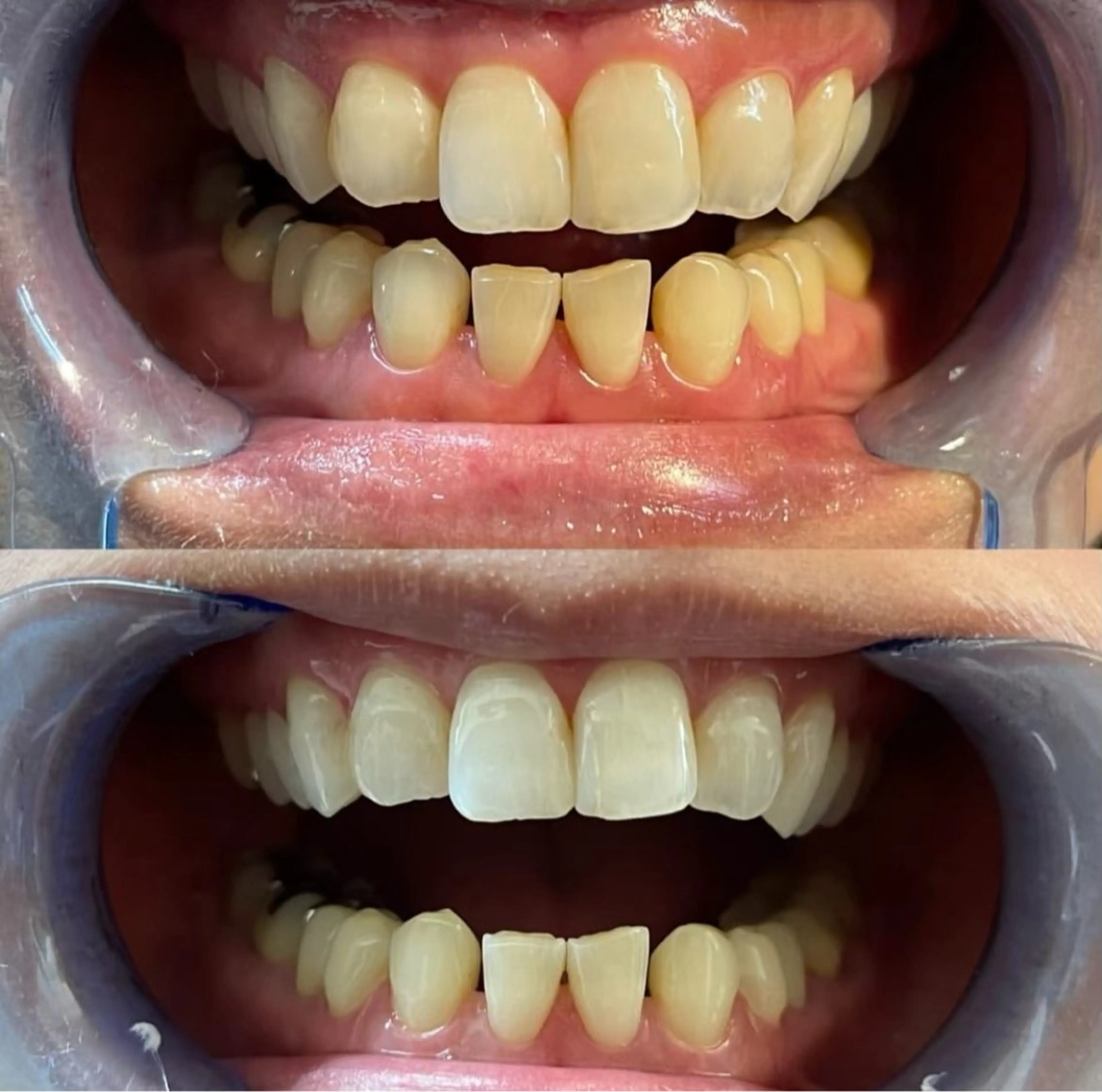 セルフホワイトニング　初回15分✕1照射の写真