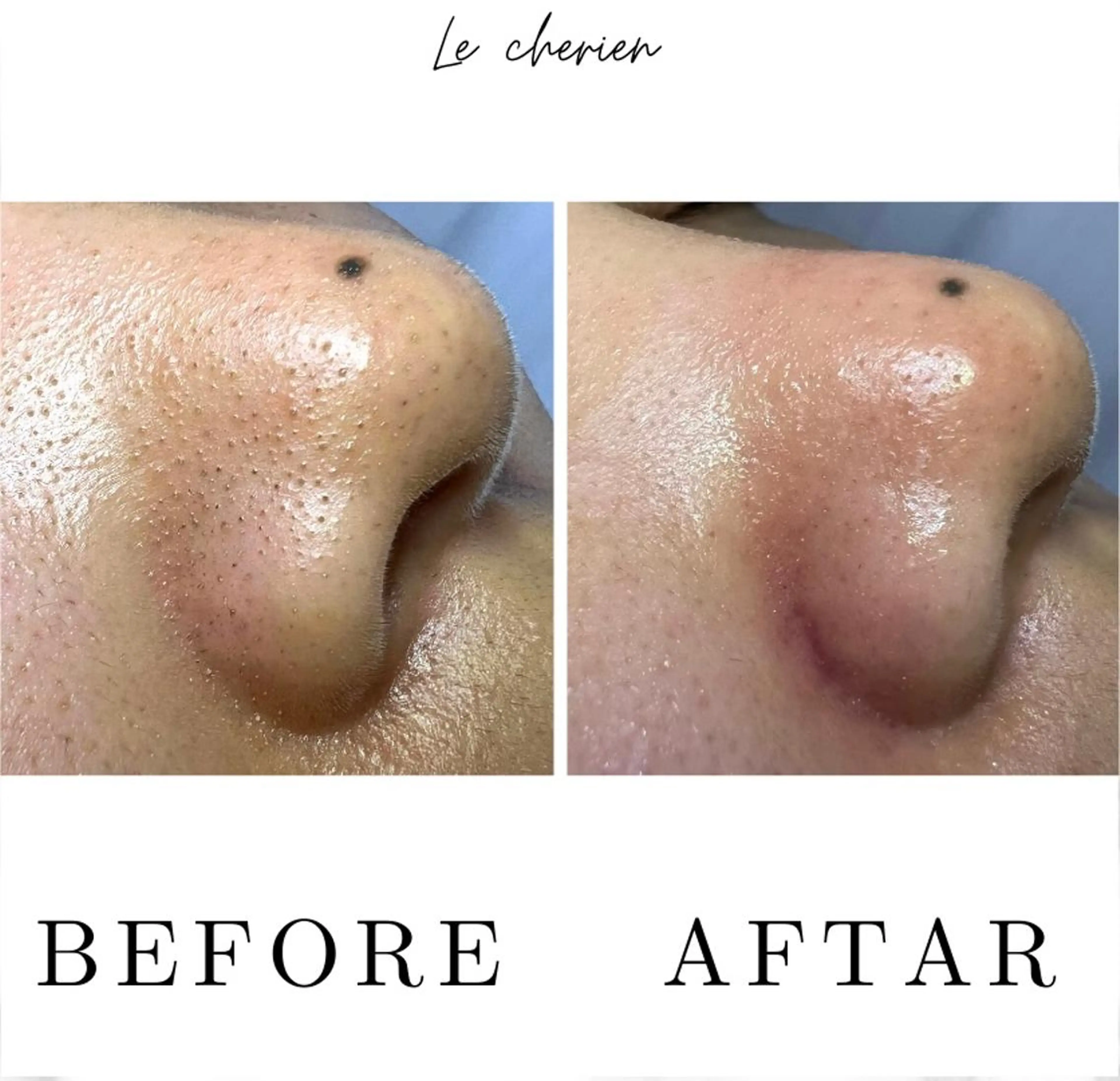 Le  cherien ル シェリア所属・毛穴洗浄/ハイフ サロンのエステ・リラクイメージ