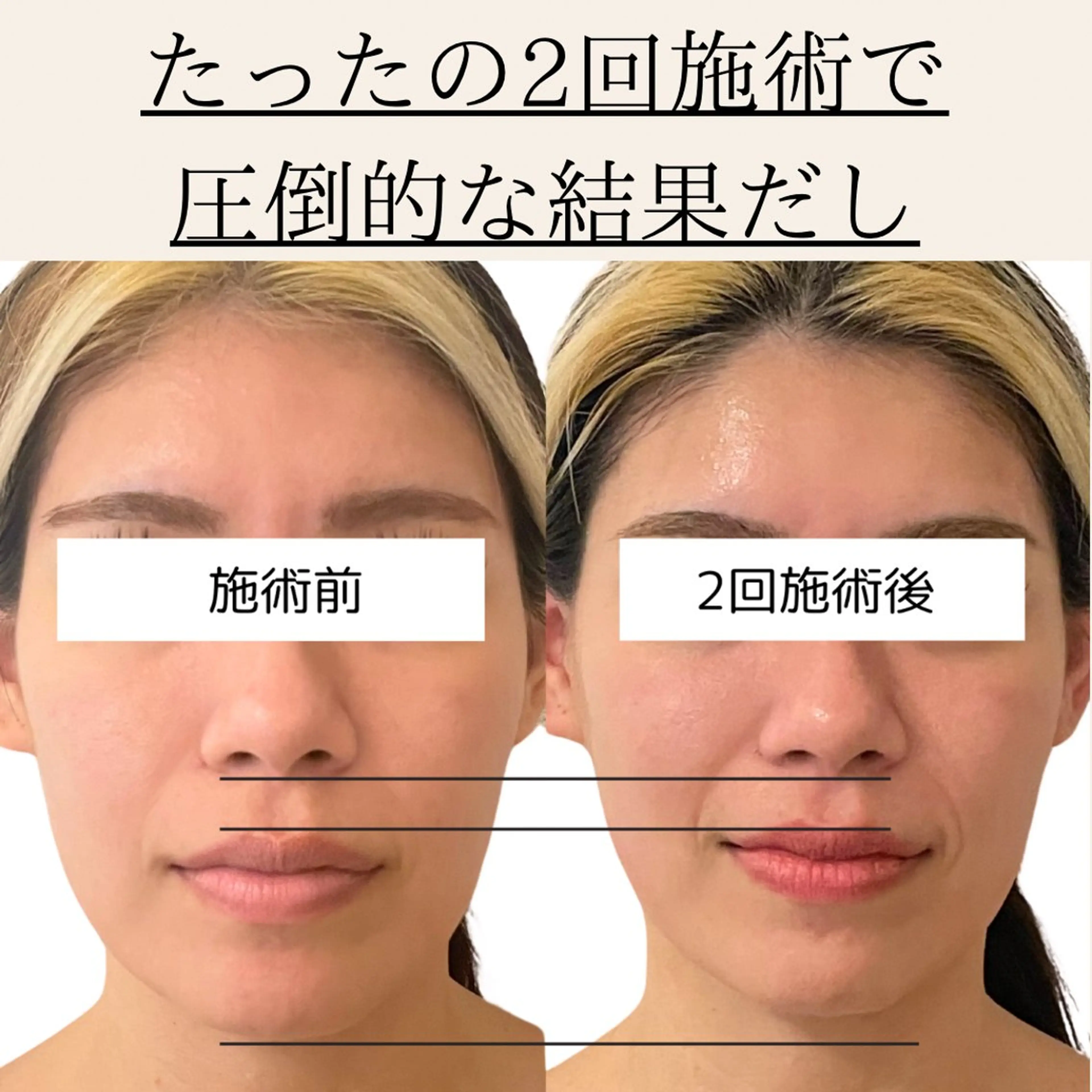 エステ 小顔/たるみ/黒ずみ除去専門サロン/SONA 大和西大寺店所属・【小顔専門看護師 サロンSONA】のエステ・リラクイメージ