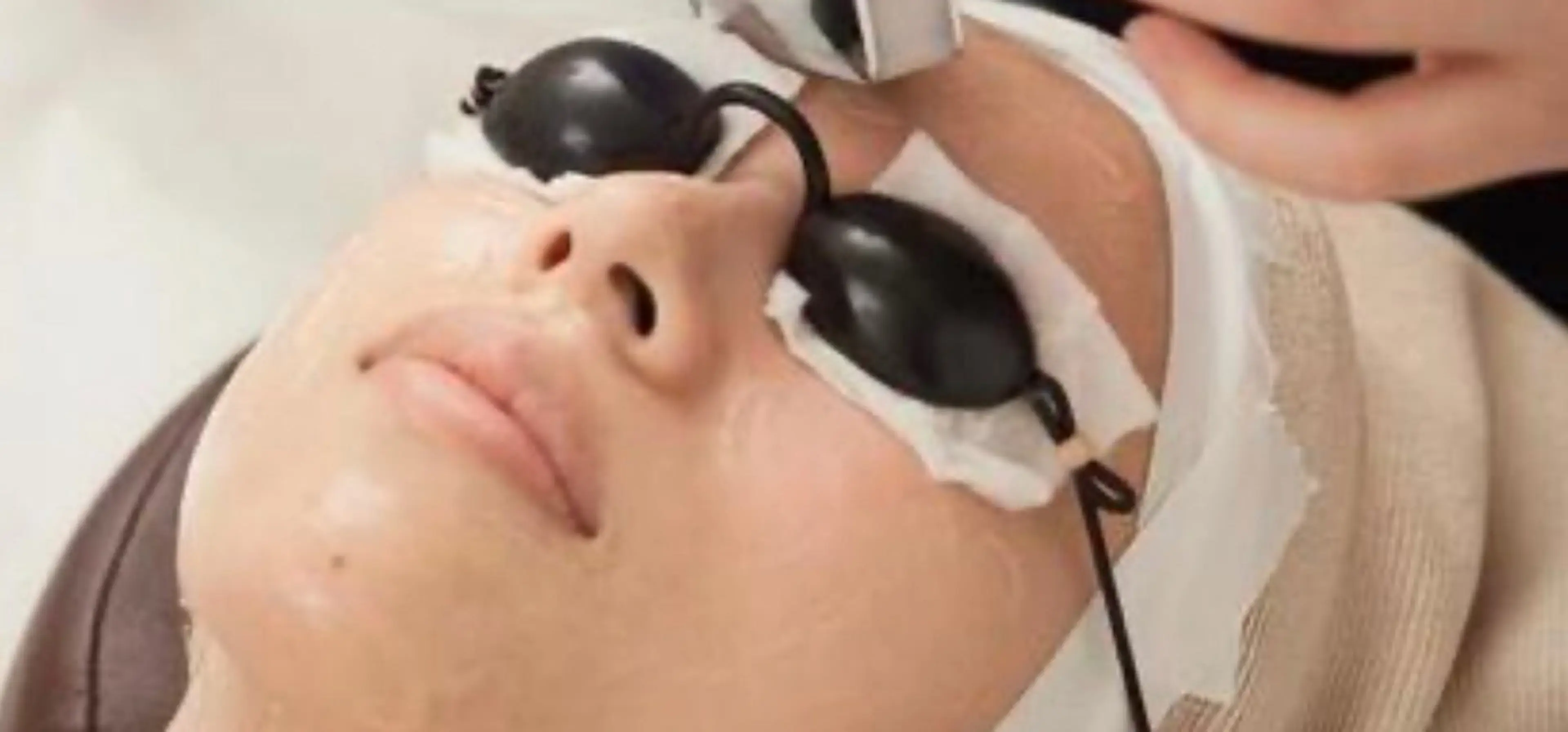 マツヤニwax脱毛✖️光脱毛おでこ・左右ほほ・鼻下・あご・あご5箇所をwax脱毛➕光脱毛➕ミネラルパックの写真