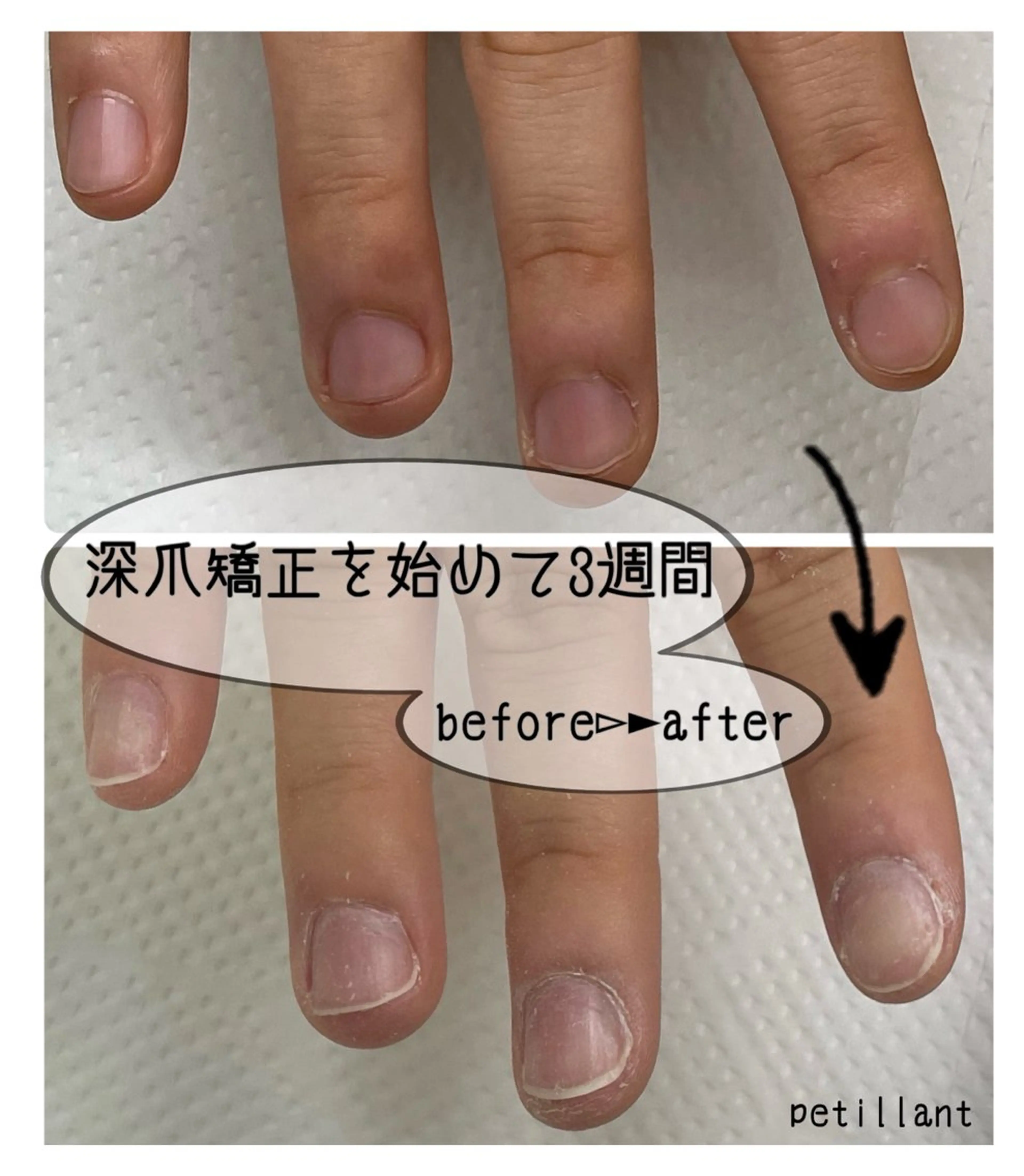 ネイル 成人式 長さ出し ジェルネイル ピンク ネイルチップ ハンドネイル ハンドケア petillant所属・nail salon petillantのネイルデザイン