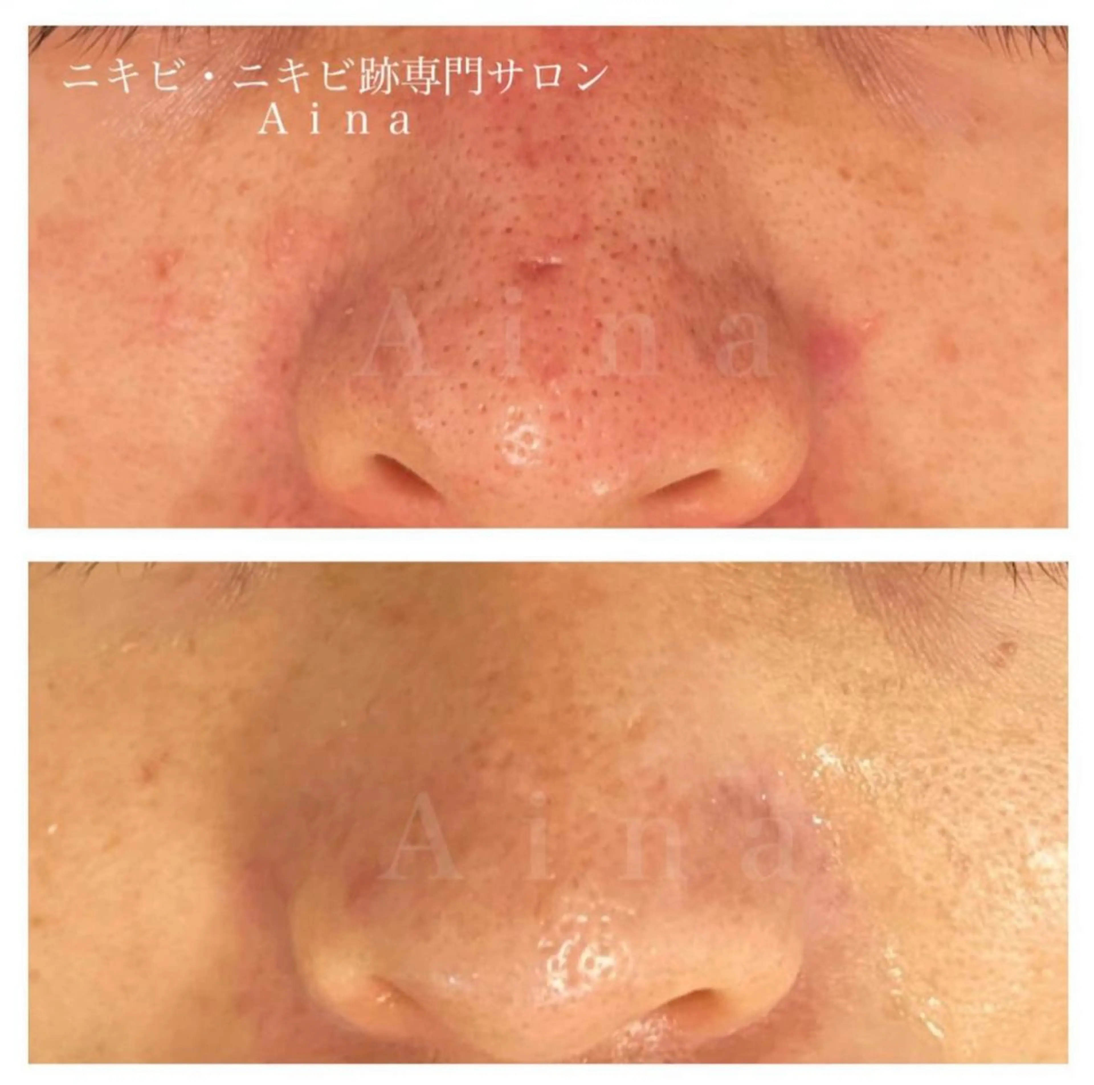 ミディアム パーマ ヘアアレンジ メンズ キッズ ネイル マツエク・マツパ アイブロウ 赤色 エステ リラク ニキビ跡専門サロン Ainaのエステ・リラクイメージ