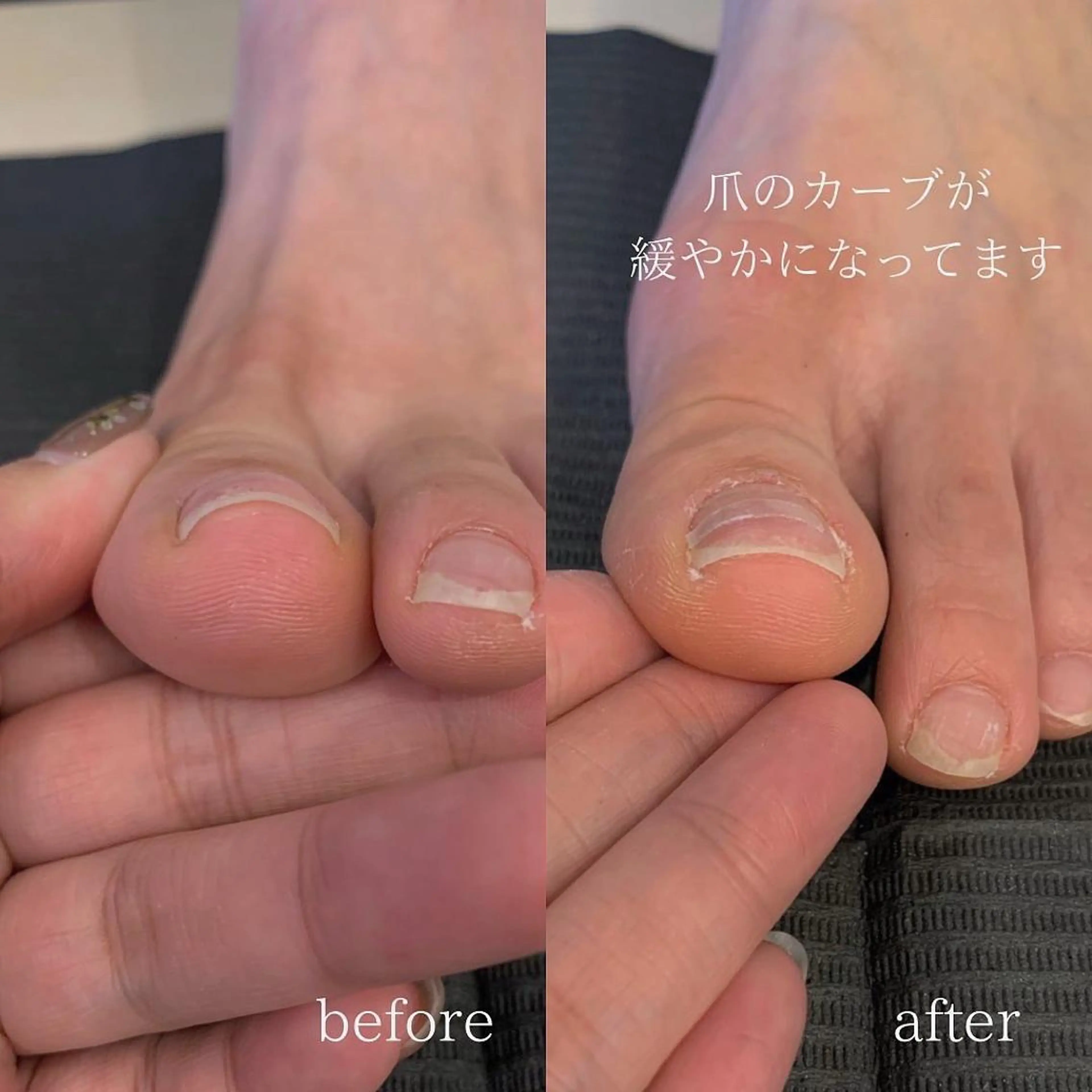 巻き爪ケアの写真