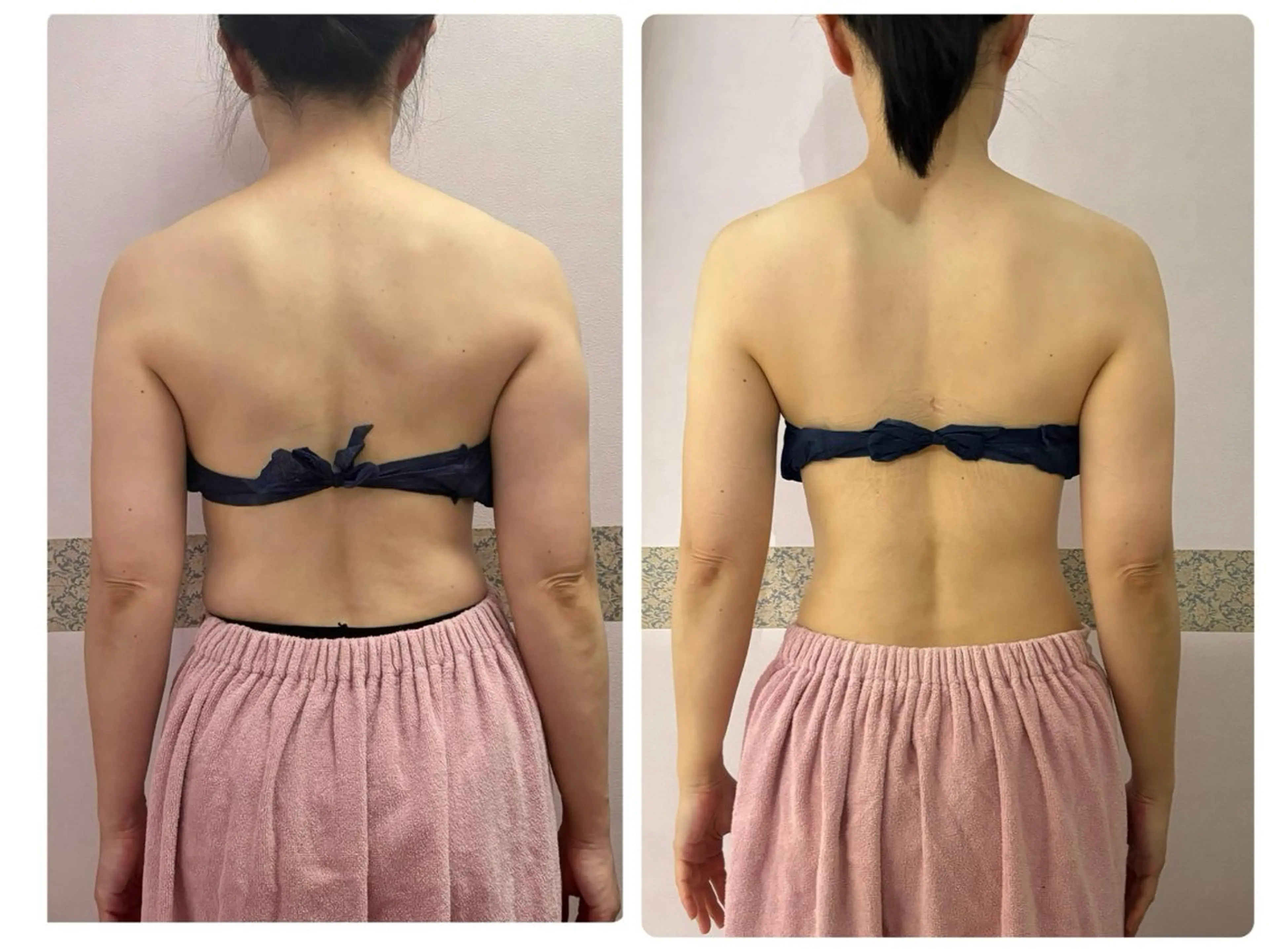 【おすすめ◎痩身・肩こり】筋膜リリース＆ラジオ波 50分の写真