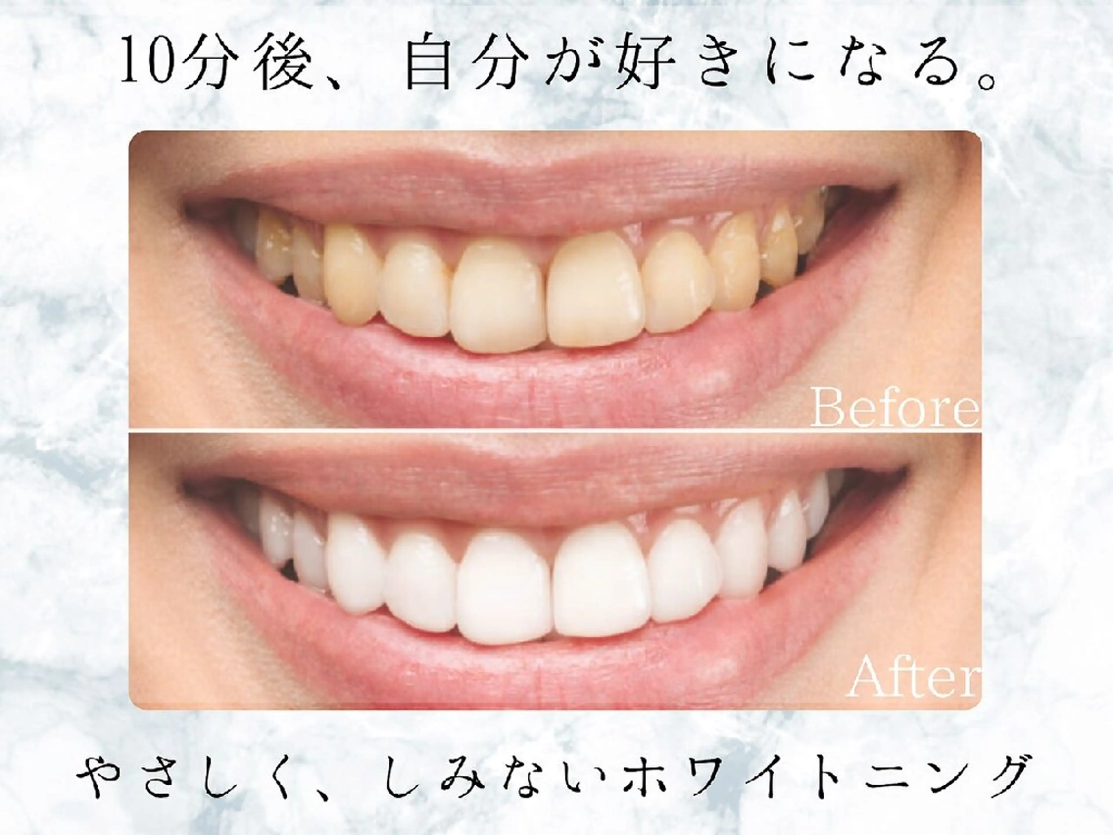 【お急ぎの方はこちら】最速プレミアムセルフホワイトニング (2来店60分照射)の写真