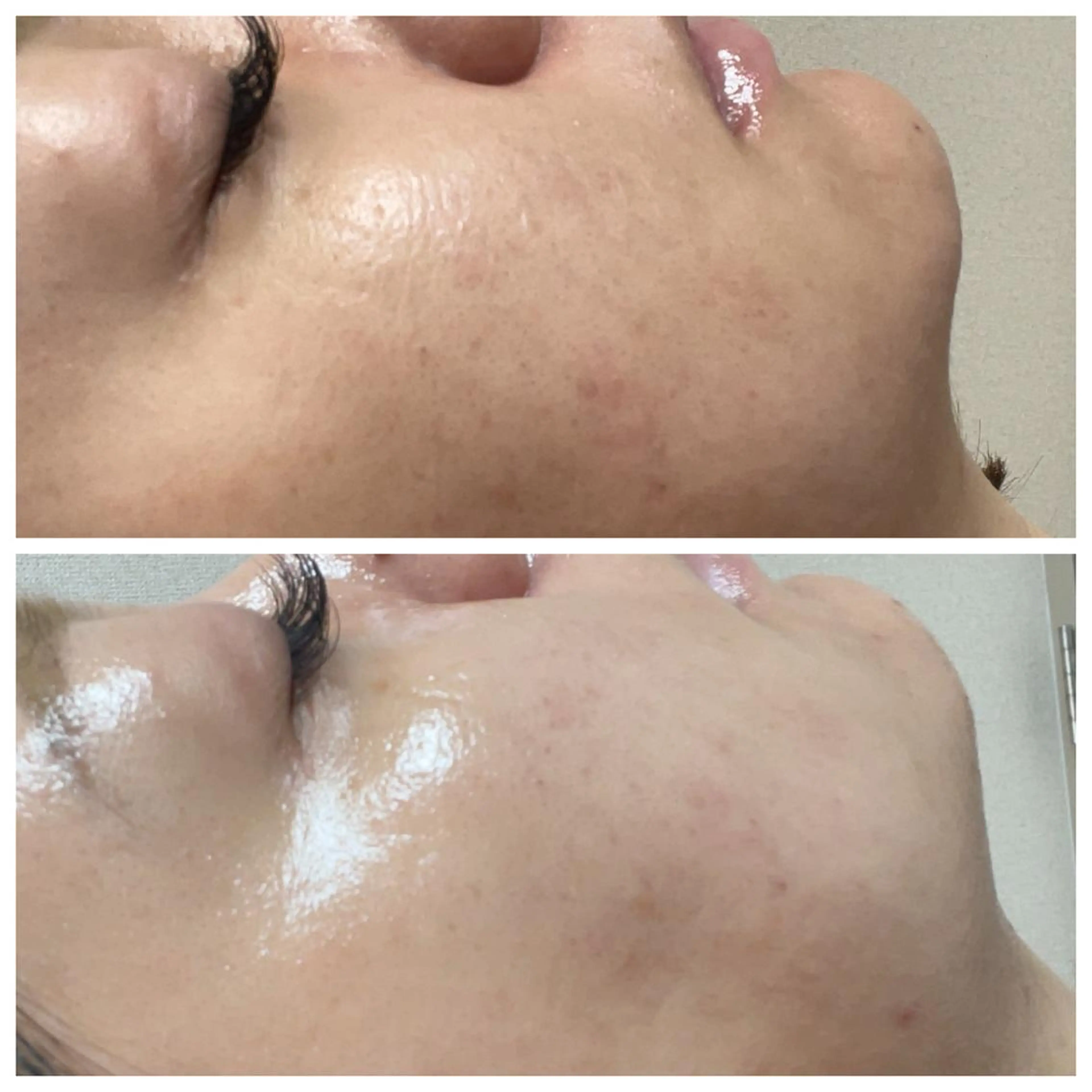 【毛穴の詰まり/いちご鼻/開き毛穴の方必見】毛穴ケア　肌引き締めコースの写真