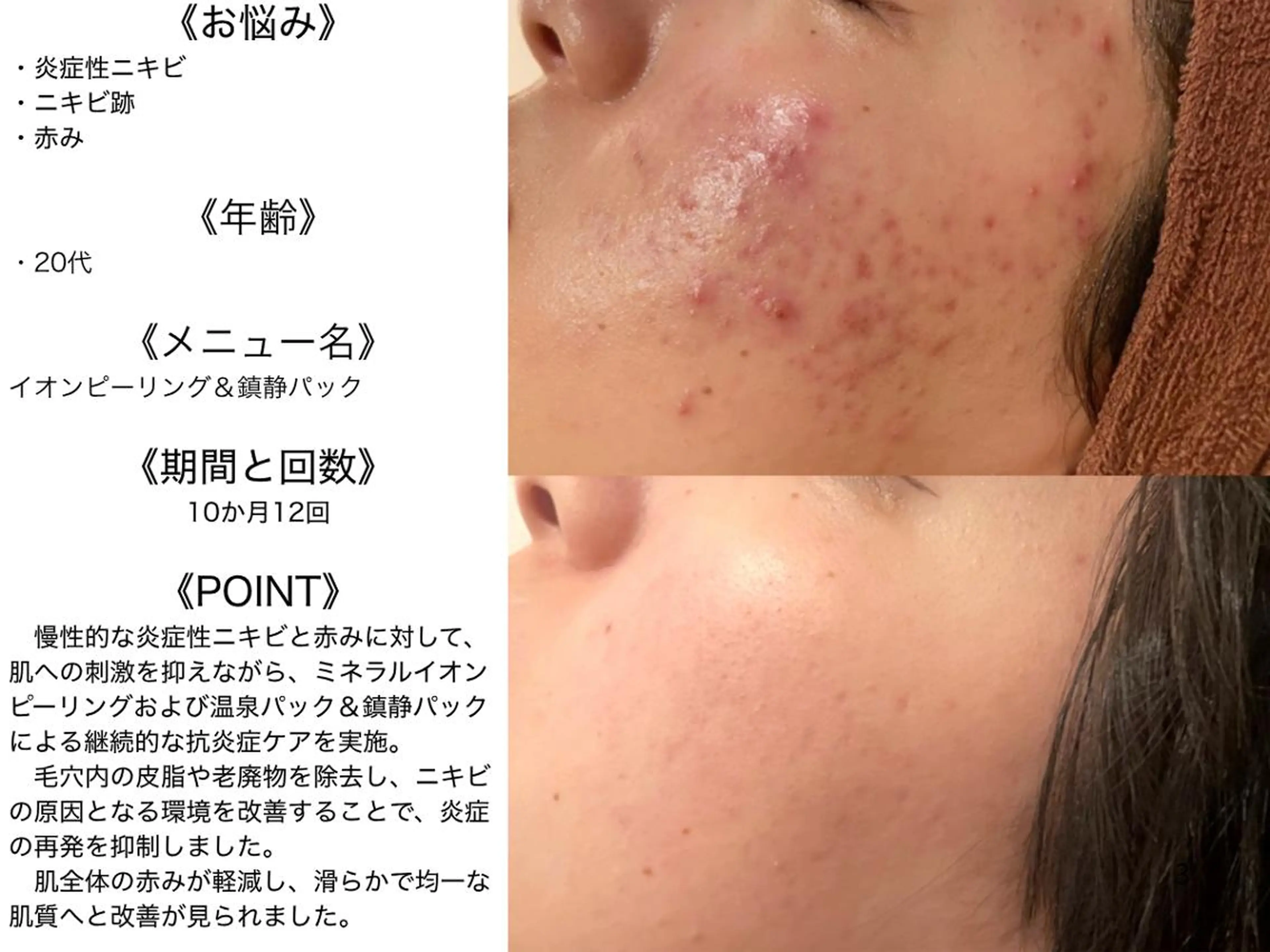 エステ リラク 夏までに肌荒れ卒業 するサロン🌻のエステ・リラクイメージ