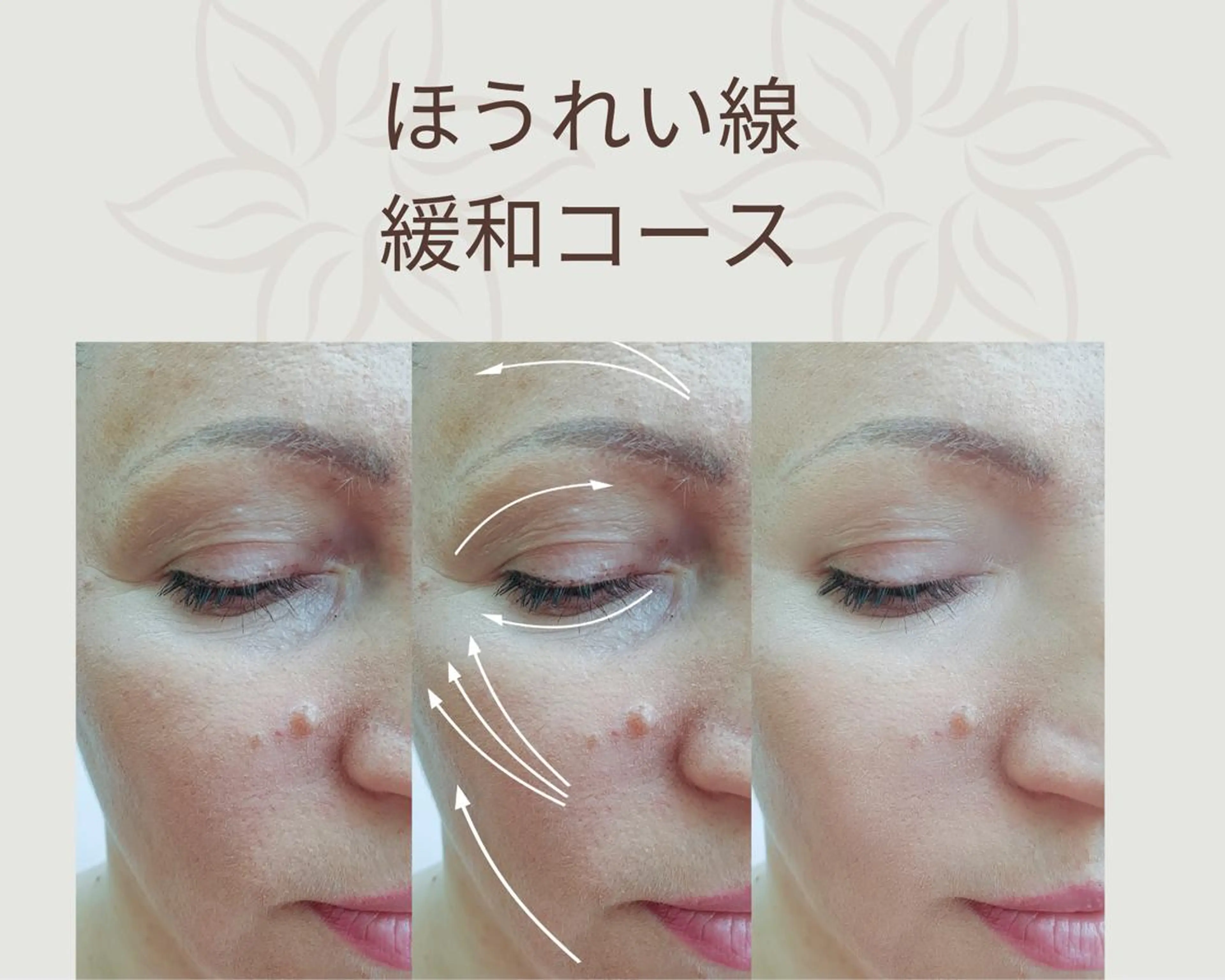 【整体フェスライン】ほうれい線　緩和コースの写真