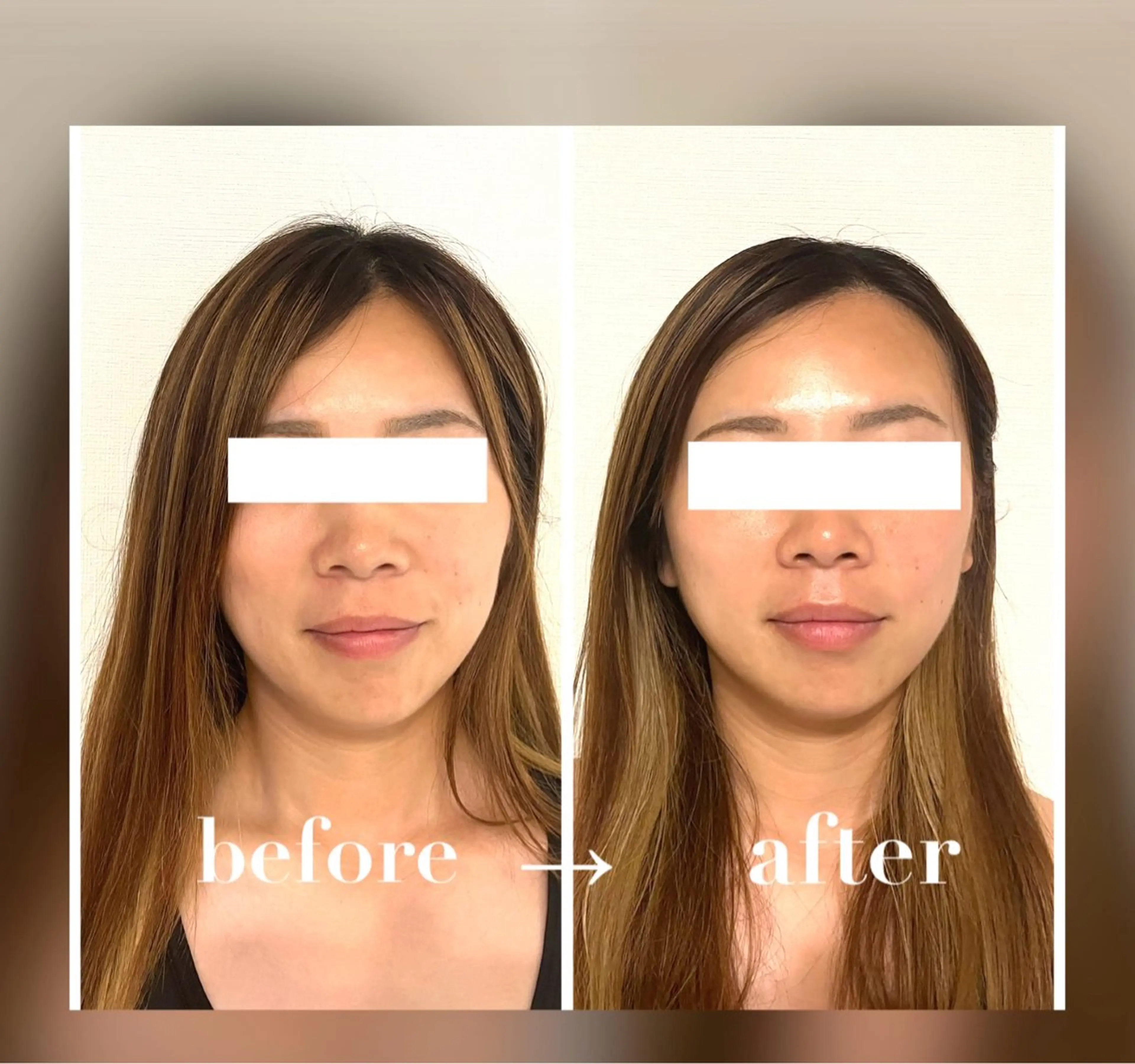 【単品メニュー】頬骨調整の写真