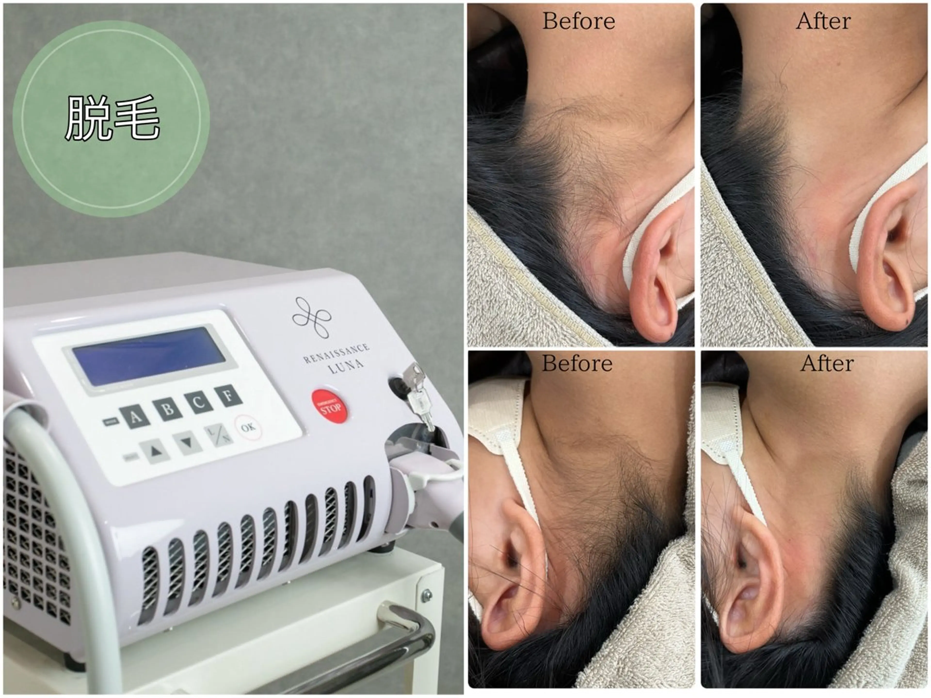 脱毛 LiLL by Andre beauty所属・LiLL 熊本のエステ・リラクイメージ