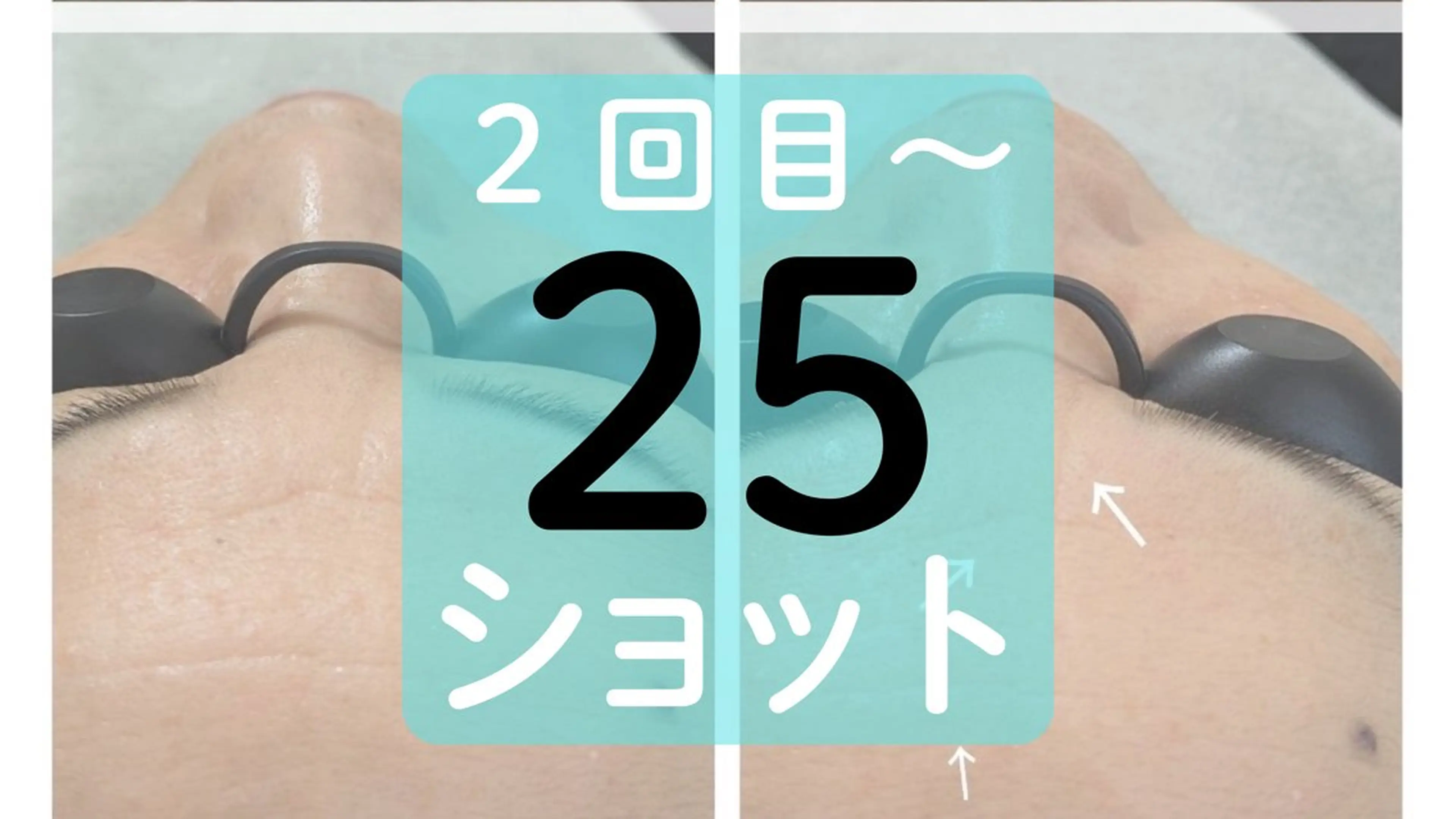 【初回価格】シワ・シミ・くすみなどお顔の部分ケアに 25ショットの写真