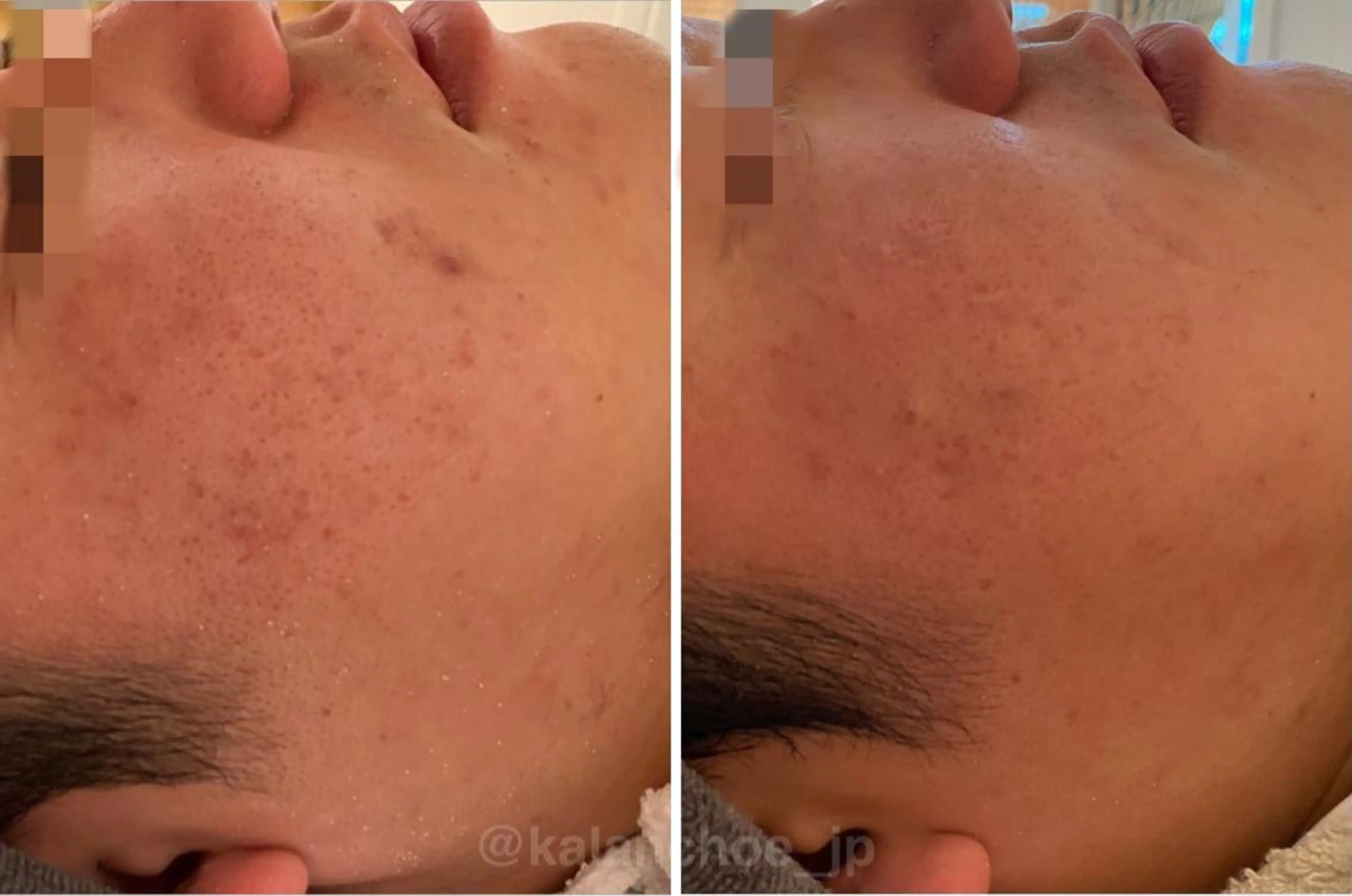 エステ 肌質改善 KALANCHOEのエステ・リラクイメージ