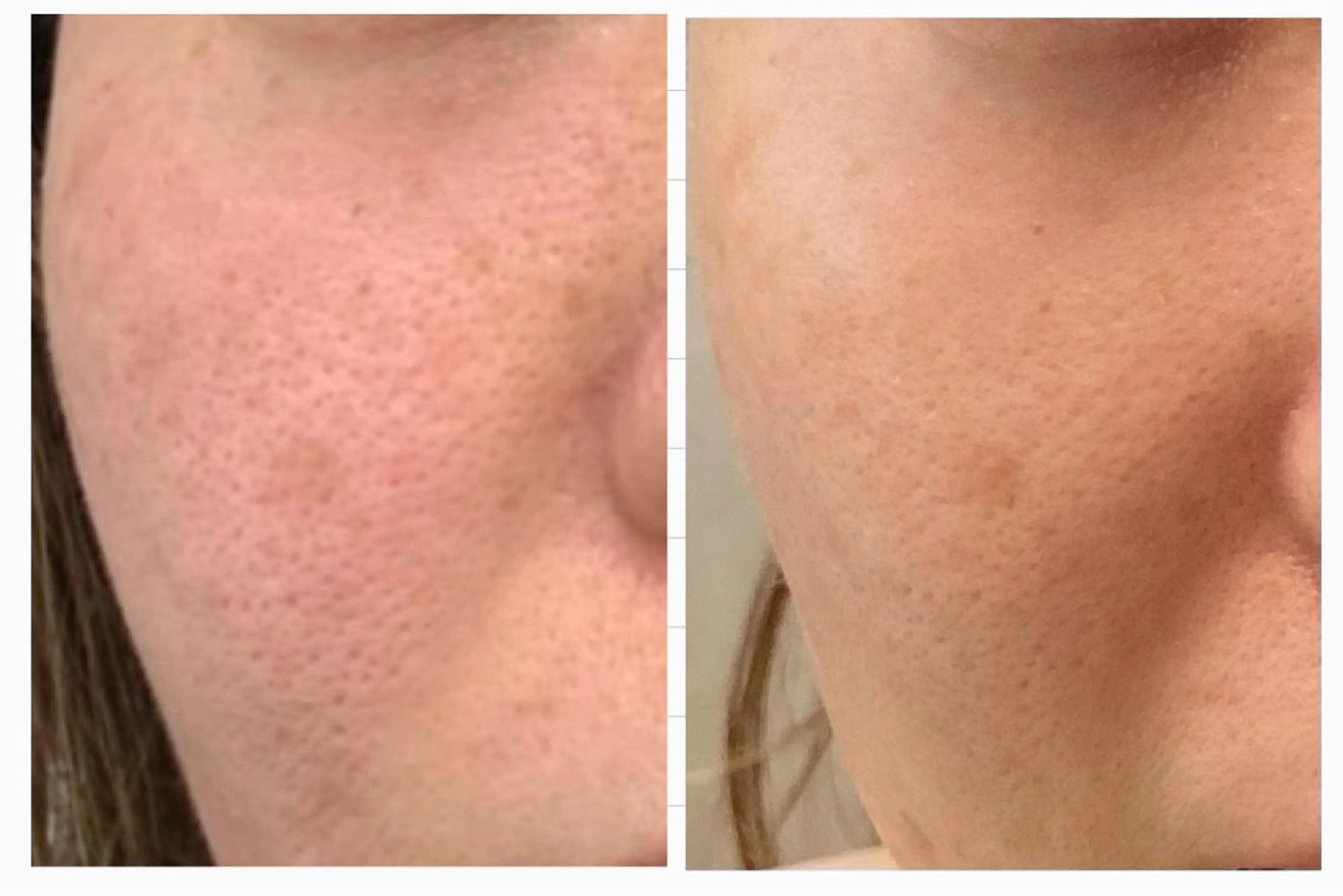 《しみ・ニキビ》乳酸ピーリング肌質改善フェイシャル《美白》の写真