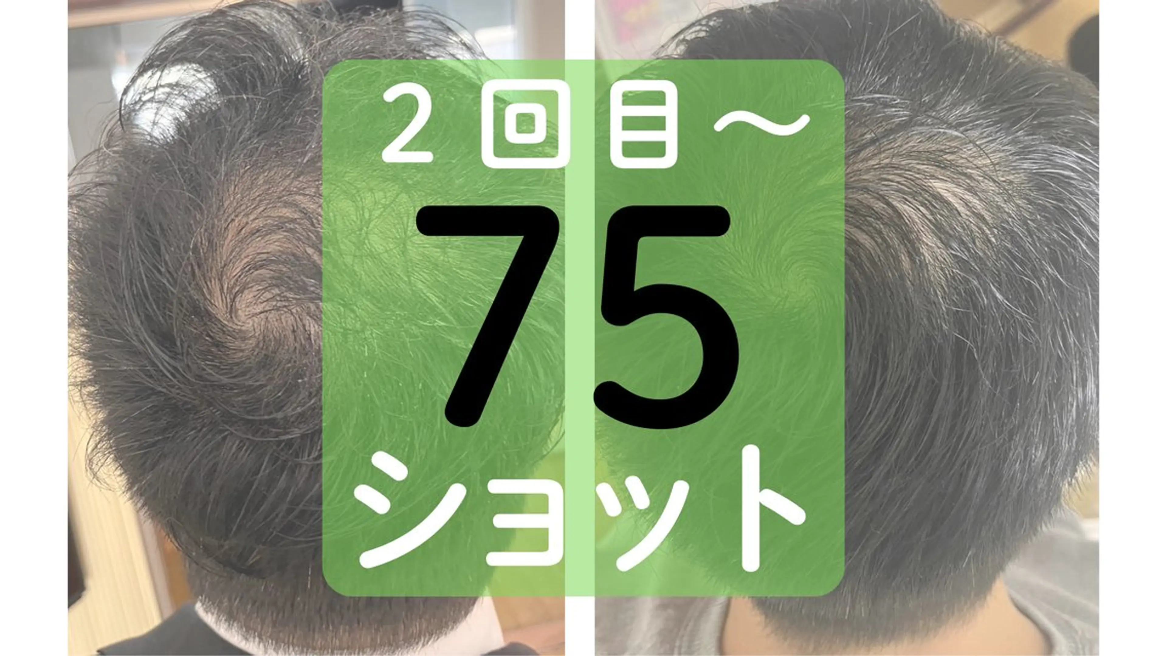 【初回価格】シワ・シミ・くすみ・たるみなどお顔全般のケアに 75ショットの写真