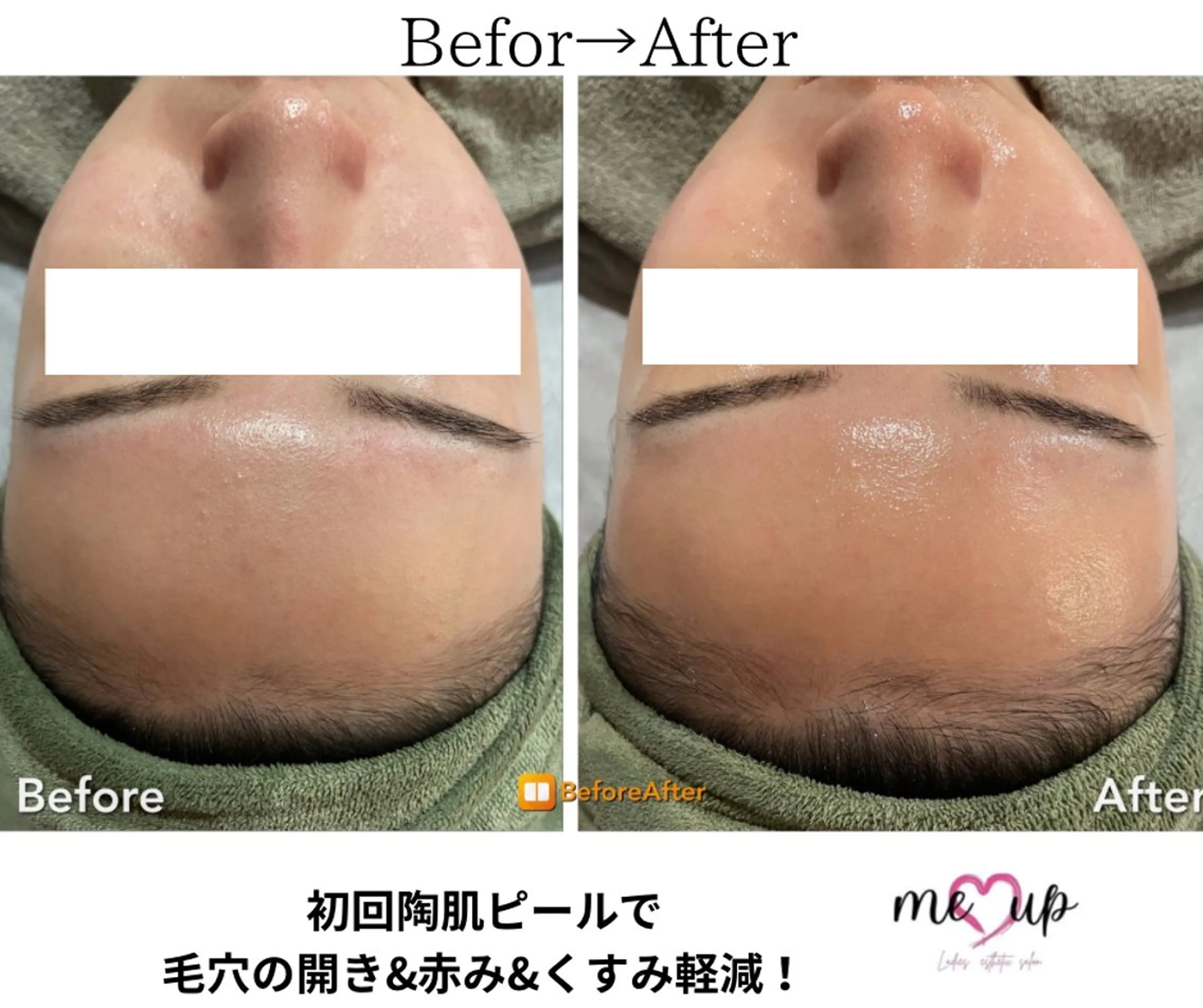 エステ Meupニキビ専門店 背中/ハーブ/肌管理のその他イメージ