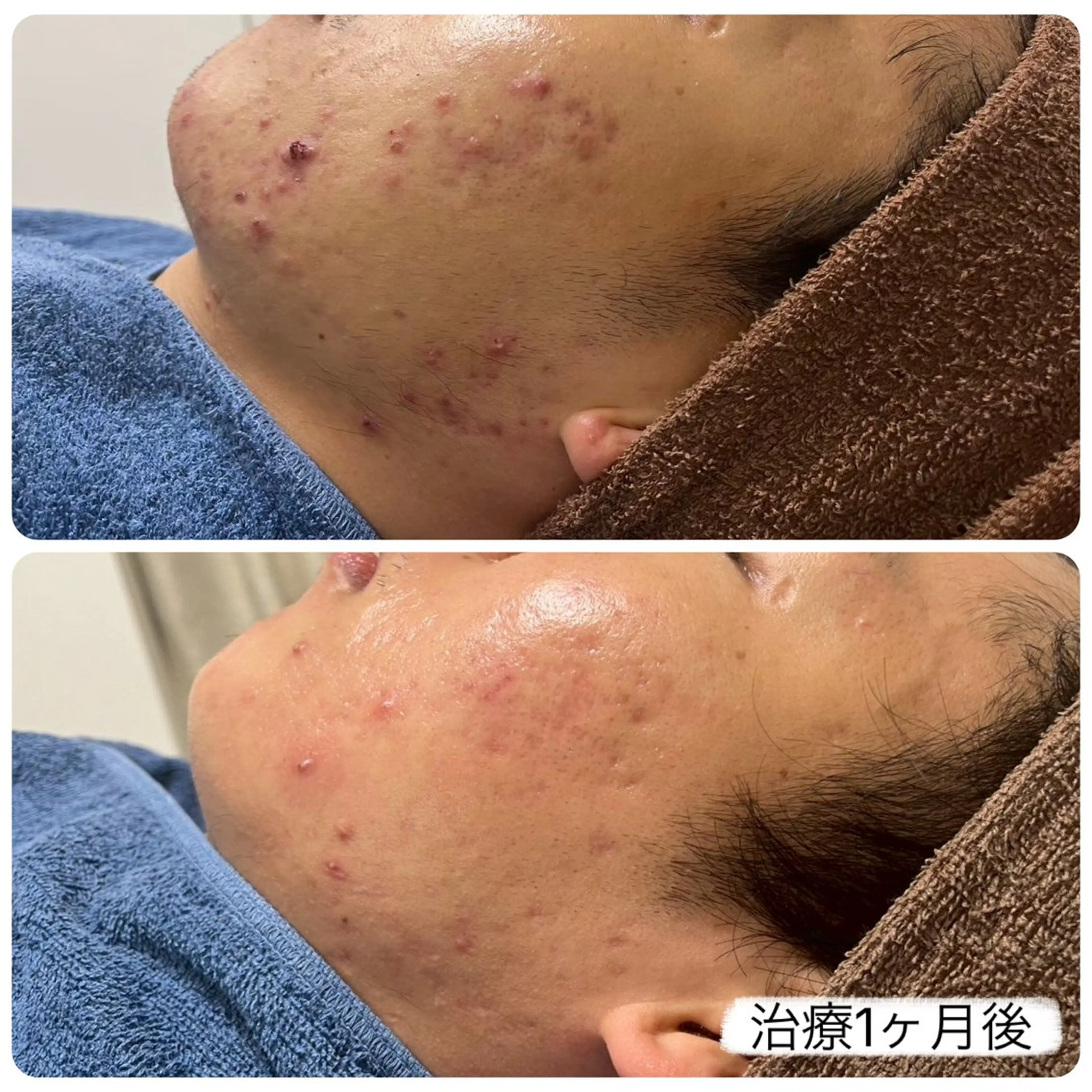 【赤ニキビ改善】 BELL'ET新宿店のエステ・リラクイメージ