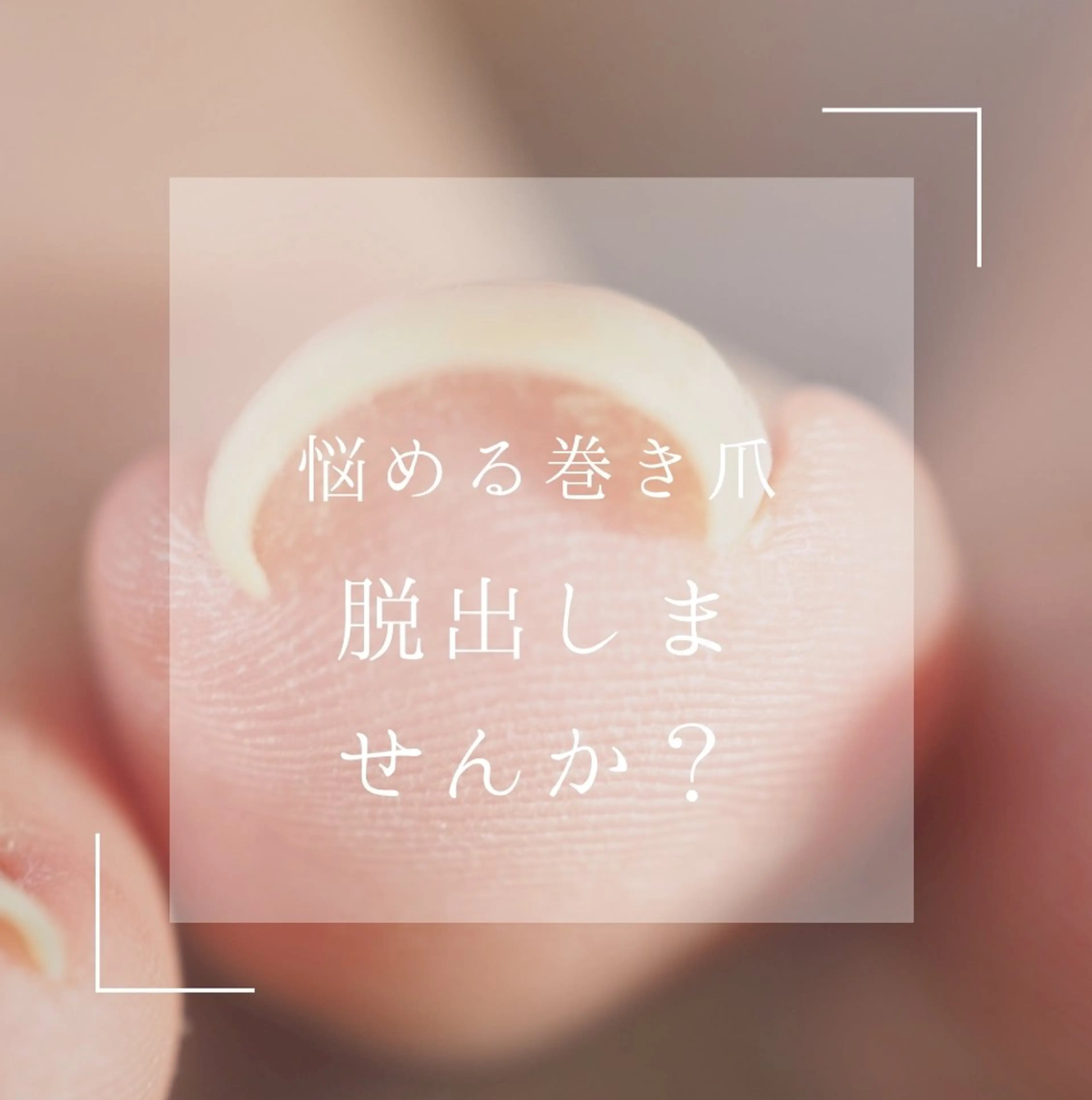 フット巻爪矯正の写真