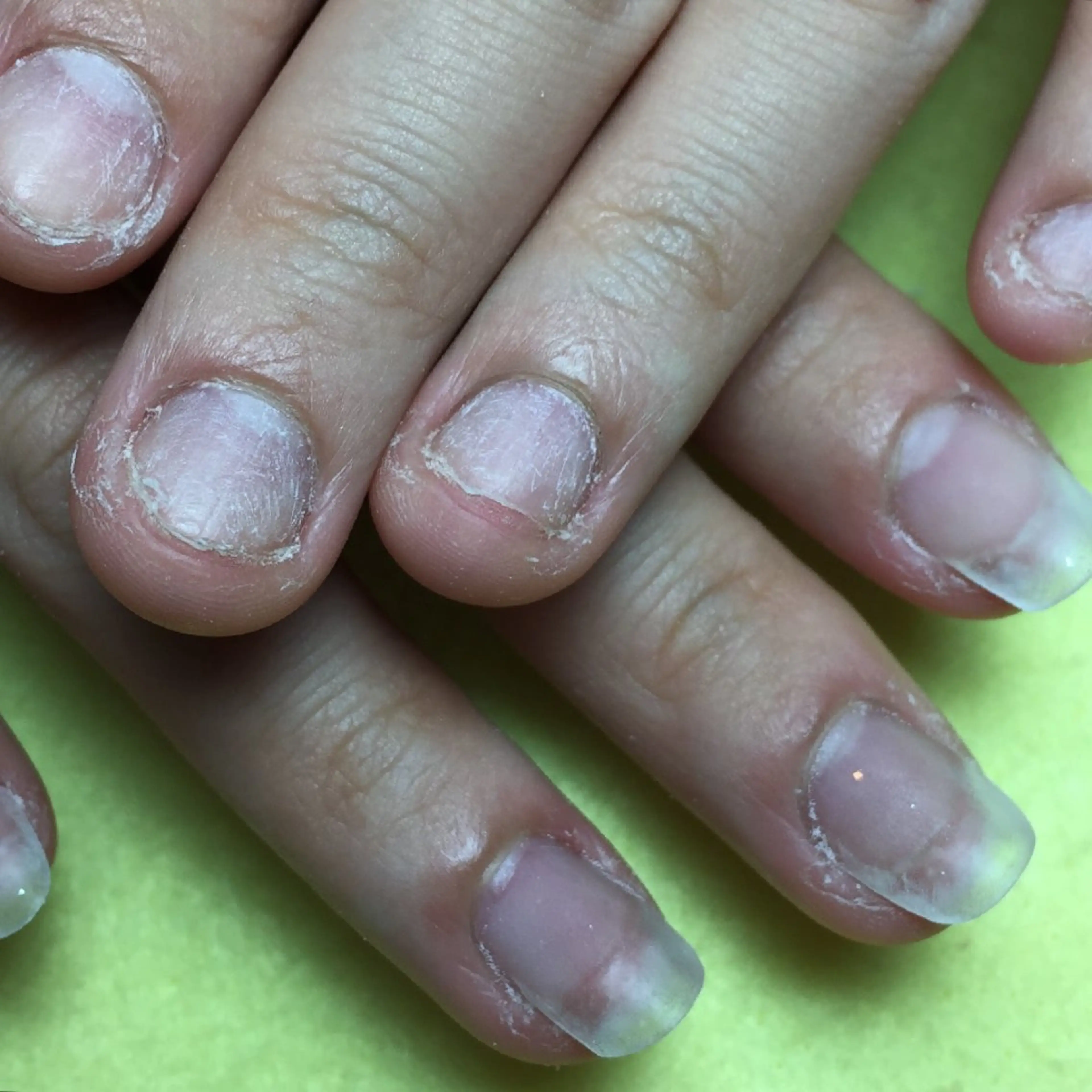 ネイル 長さ出し ハンドネイル ハンドケア 深爪矯正/爪育成ケア manie nailのネイルデザイン