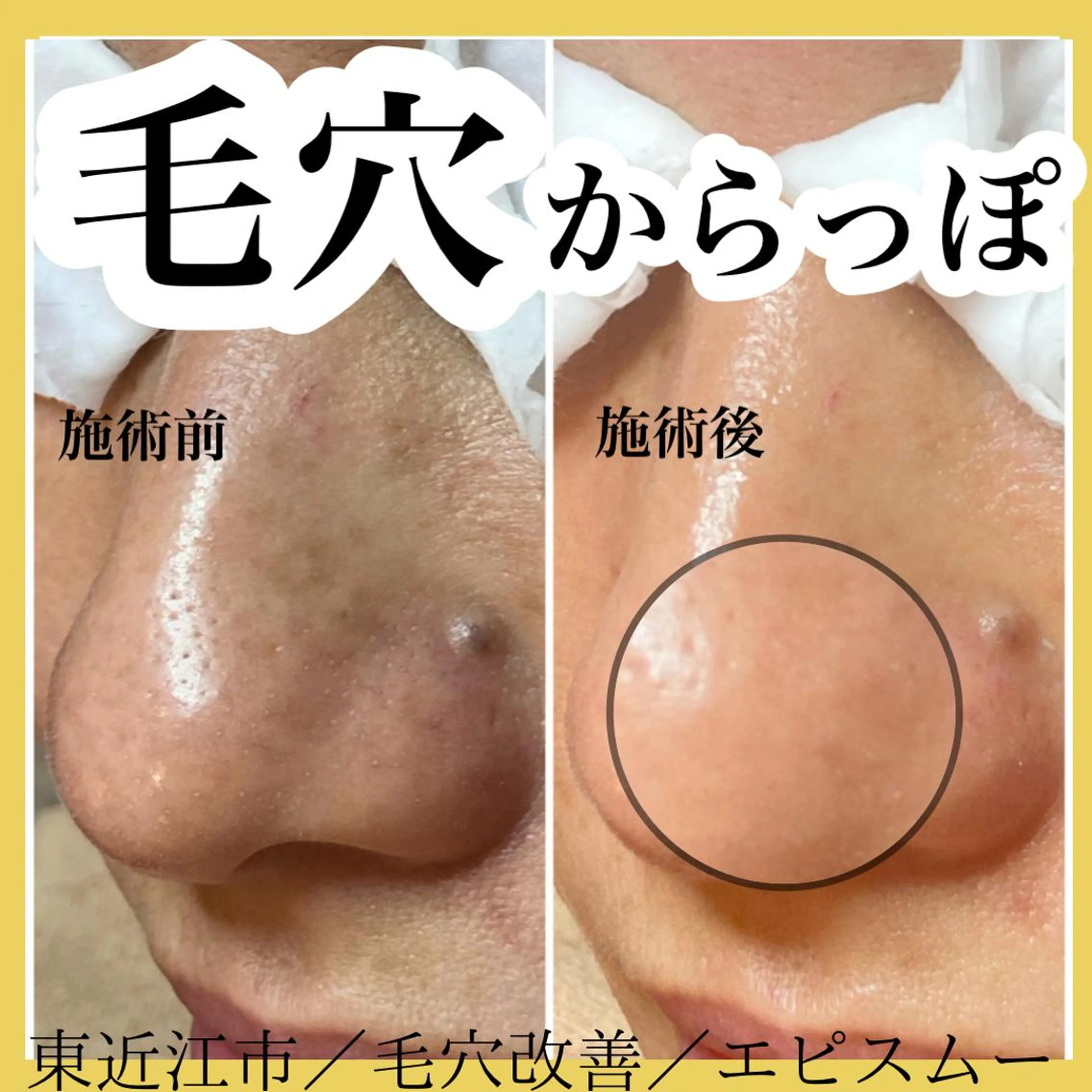 epismoo 脱毛/HBL/毛穴の眉毛・アイブロウイメージ