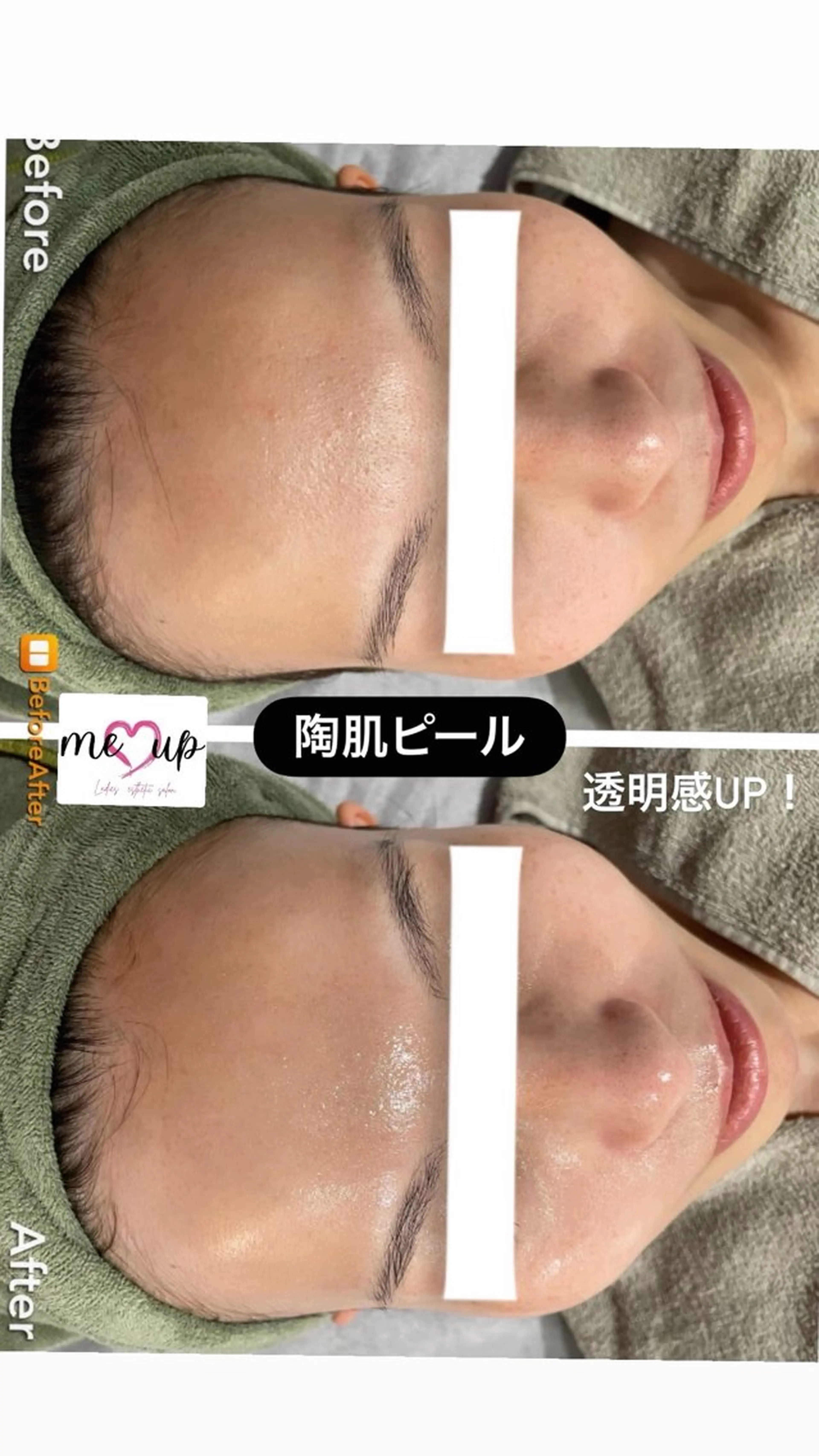 エステ Meupニキビ専門店 背中/ハーブ/肌管理のその他イメージ