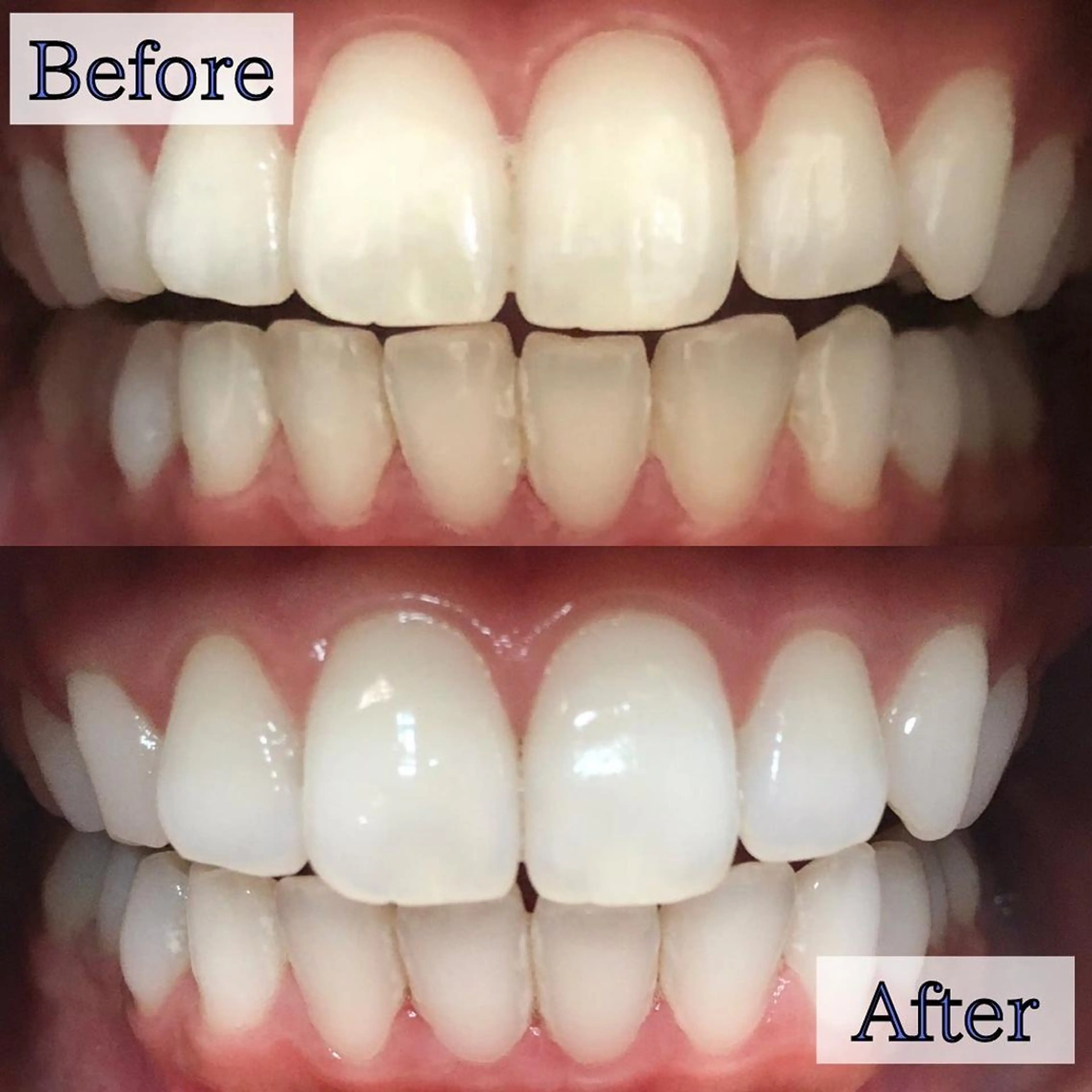 【1月限定🎍】8分照射×２回の大人気セルフホワイトニング🦷ツヤのある理想のを目指しましょう❄️の写真