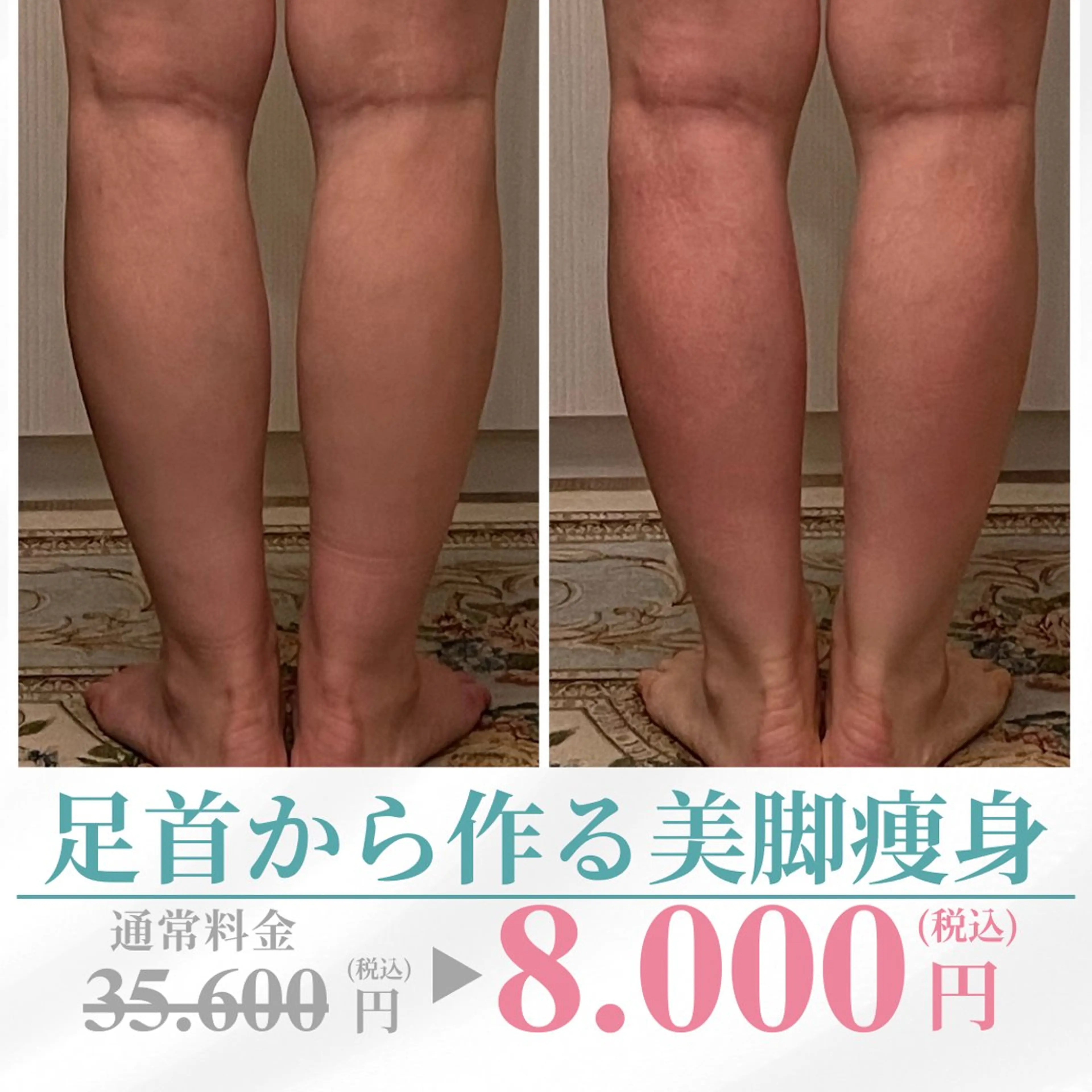 【脚やせ90分1回痩身】太ももスッキリ＆お尻キュッと引き上げ凸凹脂肪セルライトぶっ壊す！の写真