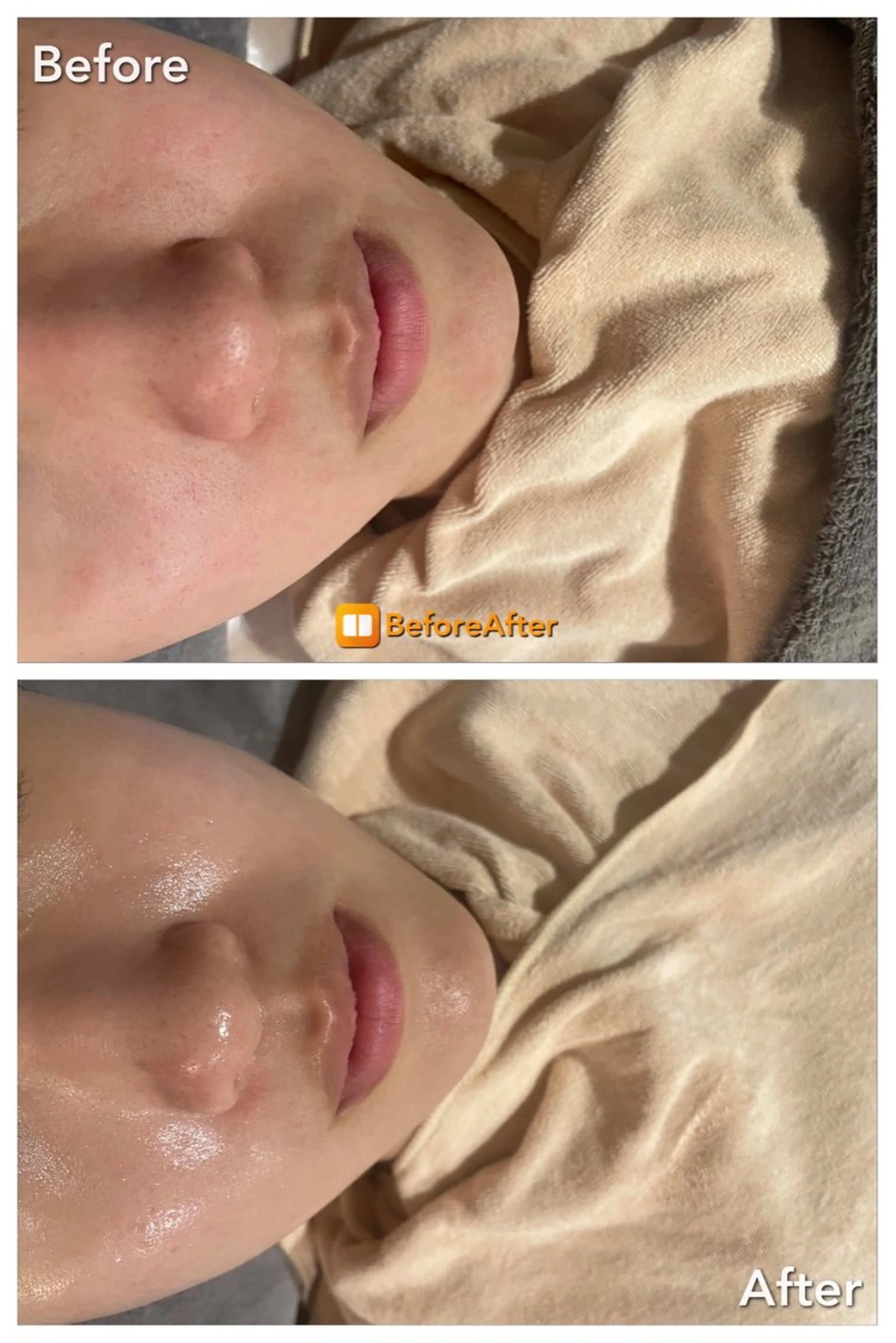 エステ Meupニキビ専門店 背中/ハーブ/肌管理のその他イメージ