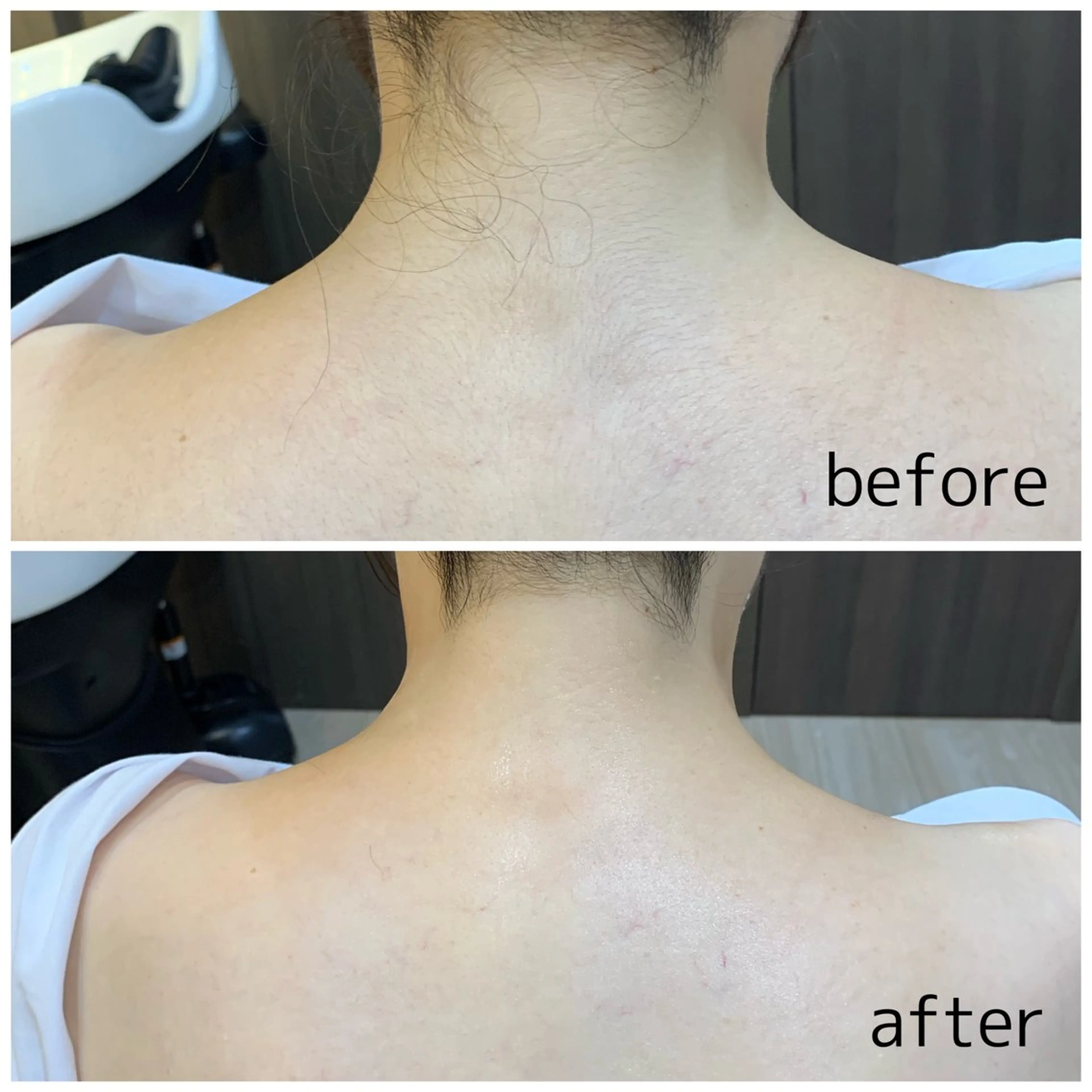 《お写真のご協力🙏》	【ツルッと滑らか素肌】背中ピーリング＋ボディシェービング(襟足、背中、デコルテ)３種の写真