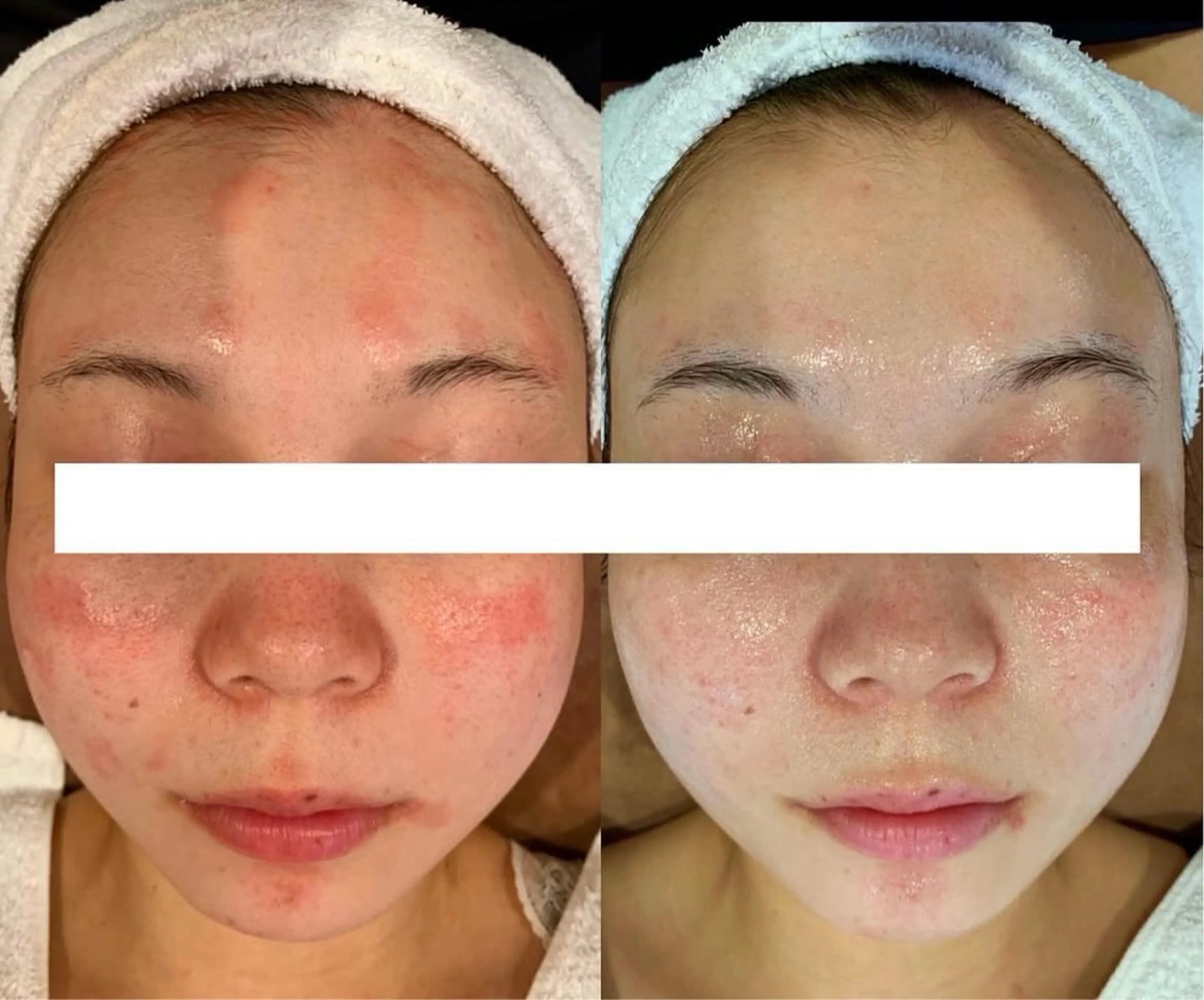 【敏感肌】花粉＊アトピー＊アレルギー＊専用商材使用フェイシャルエステ🫧お肌は生まれ変わる🫧の写真