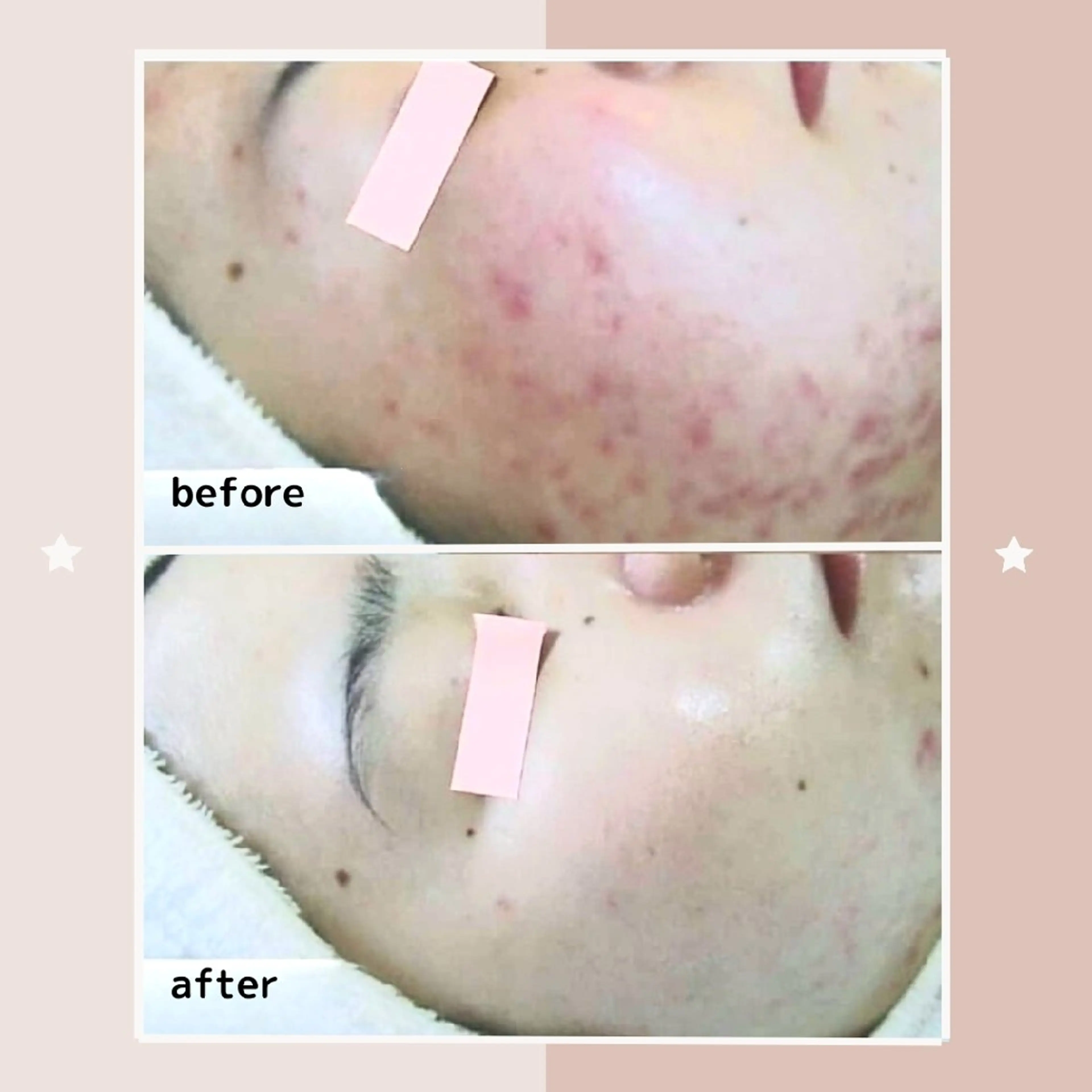 ニキビケア＆ニキビ跡 レゾン京橋店　のエステ・リラクイメージ