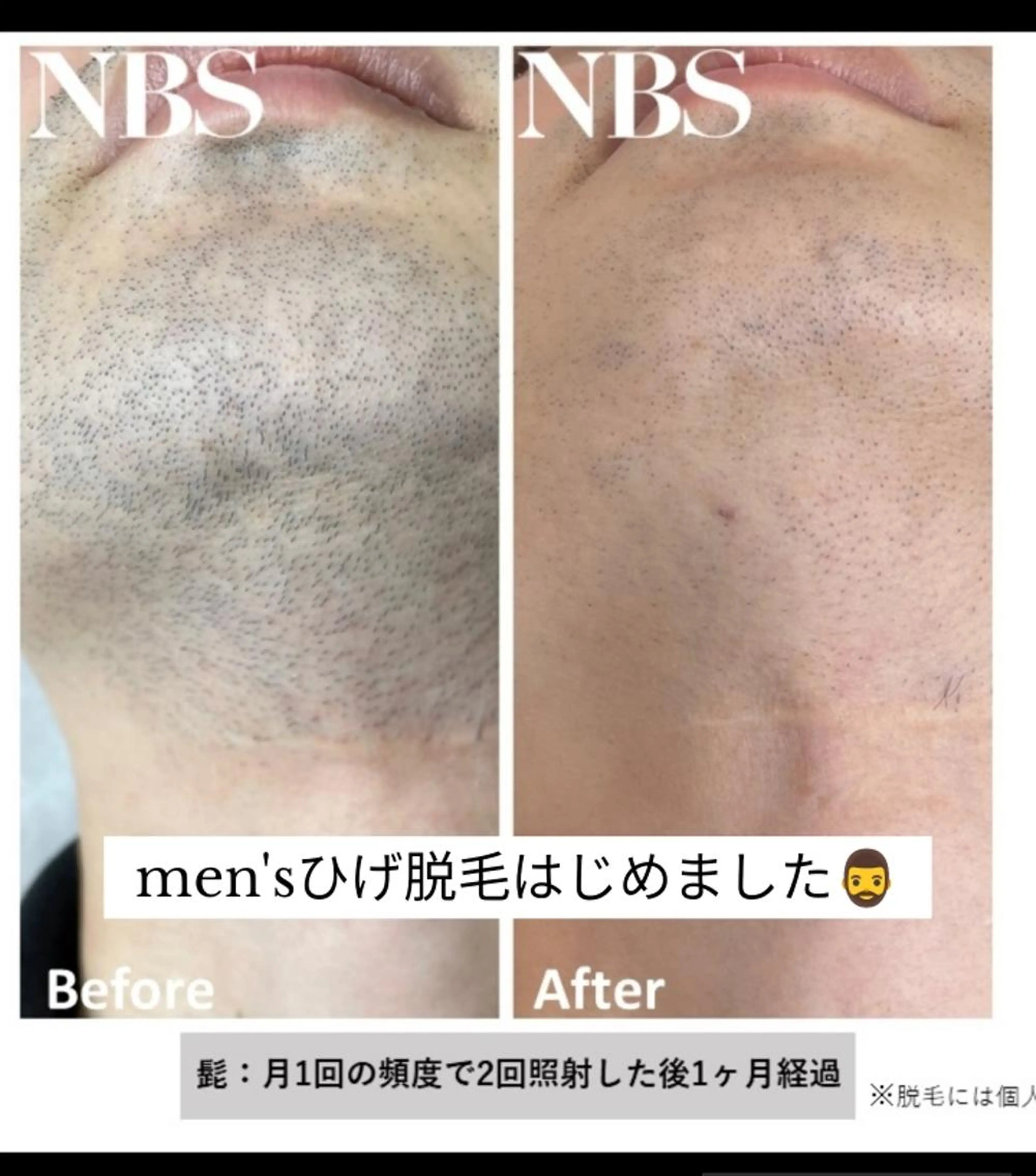 メンズヒゲ脱毛☆顔全体美肌脱毛の写真