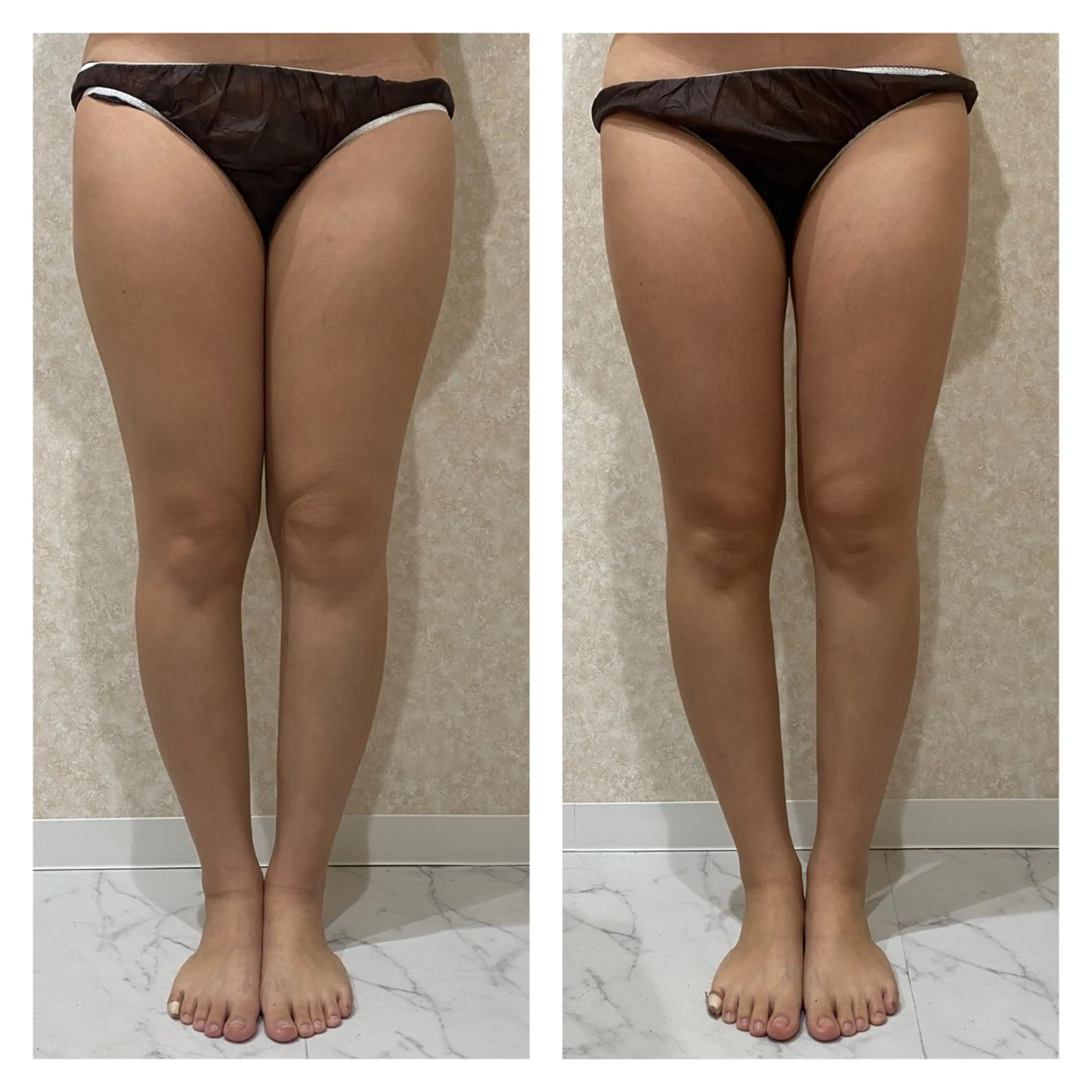 6月限定【痩身マシン＋脚コルギ 60分】脚の浮腫と脂肪に徹底アプローチ‼️夏までに太ももに隙間を🔥の写真