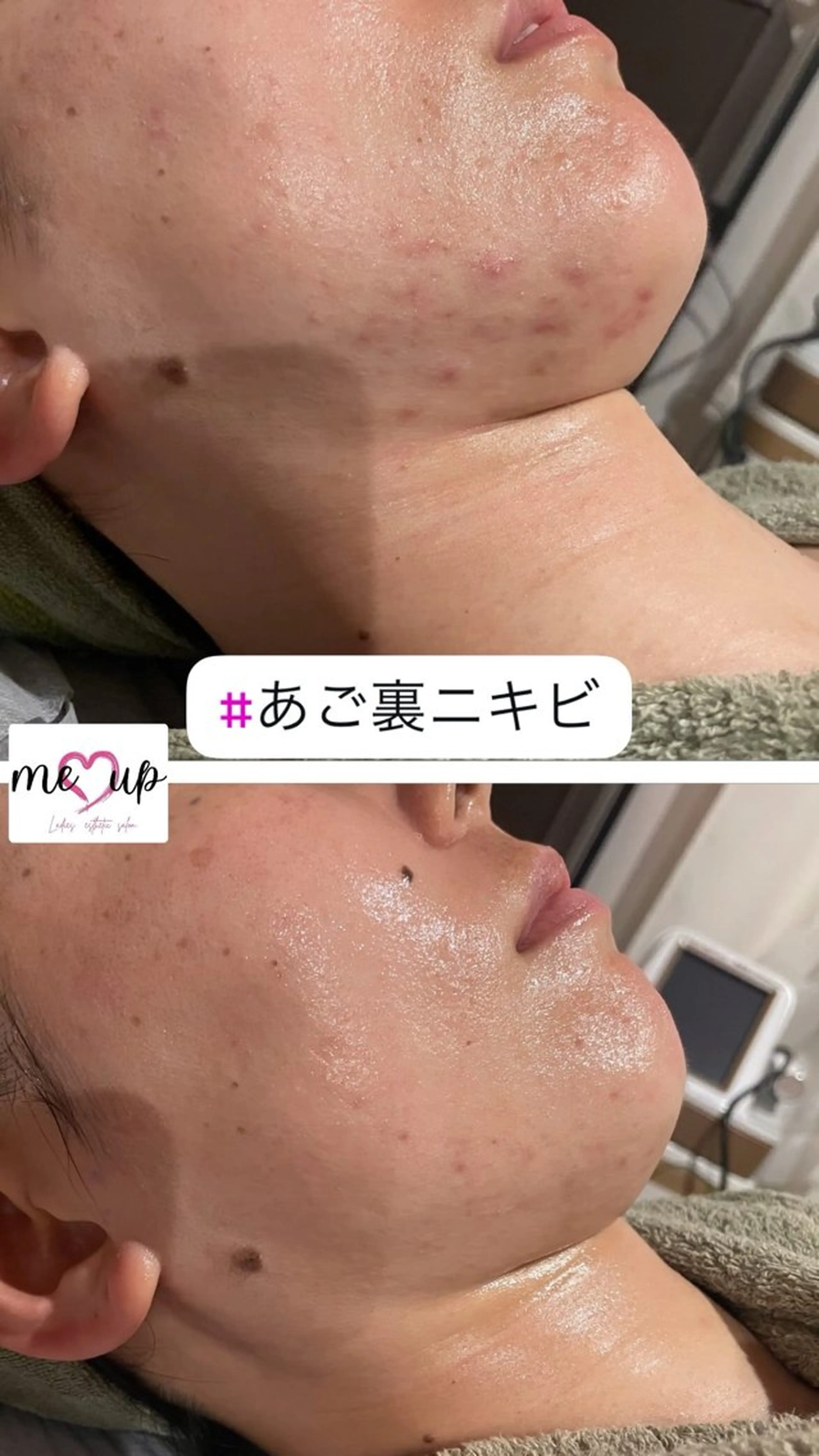 エステ Meupニキビ専門店 背中/ハーブ/肌管理のその他イメージ