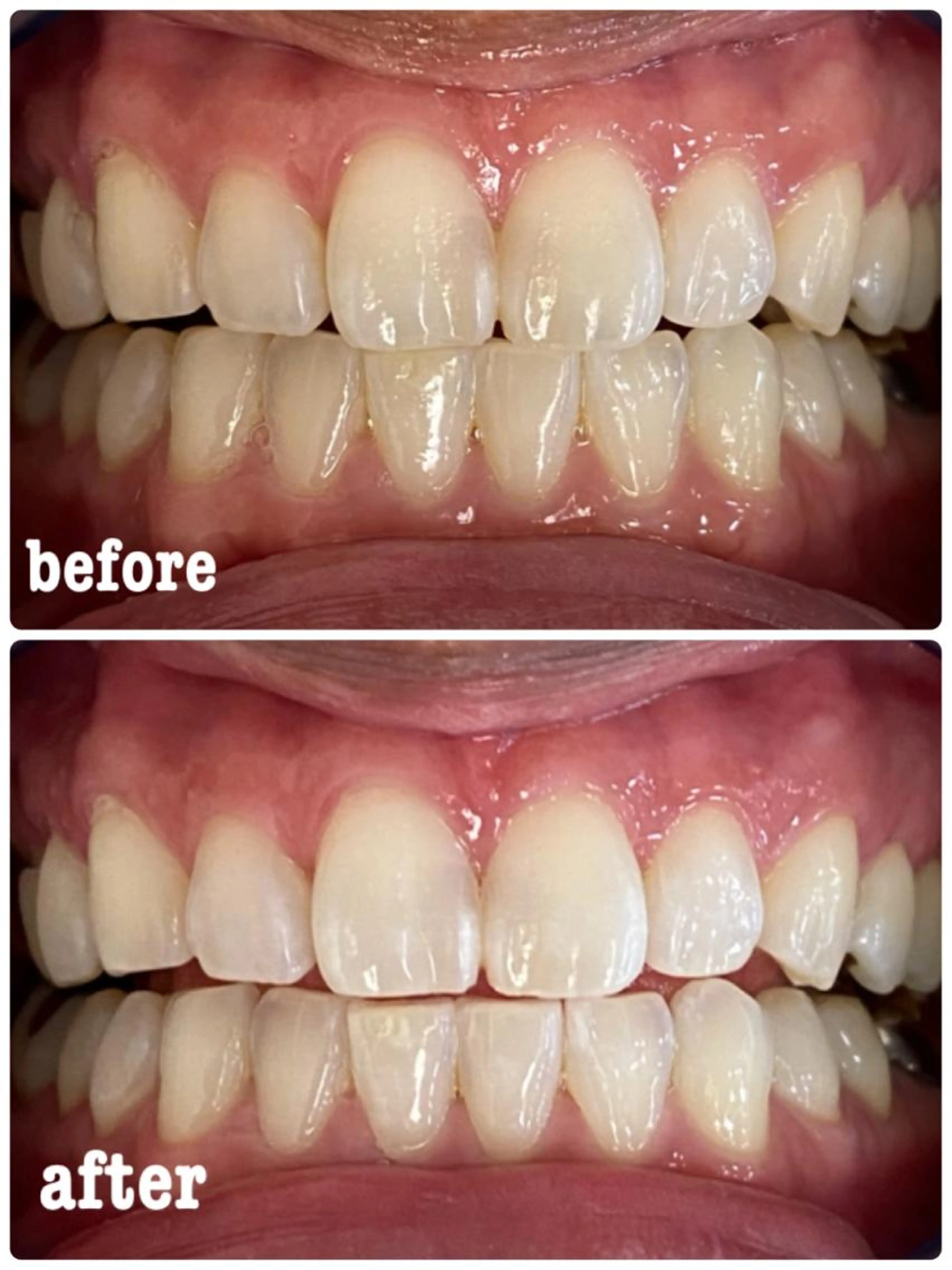 先着5名限定！自然に白くなるセルフホワイトニング✨ 今だけ《照射1回サービス》の写真