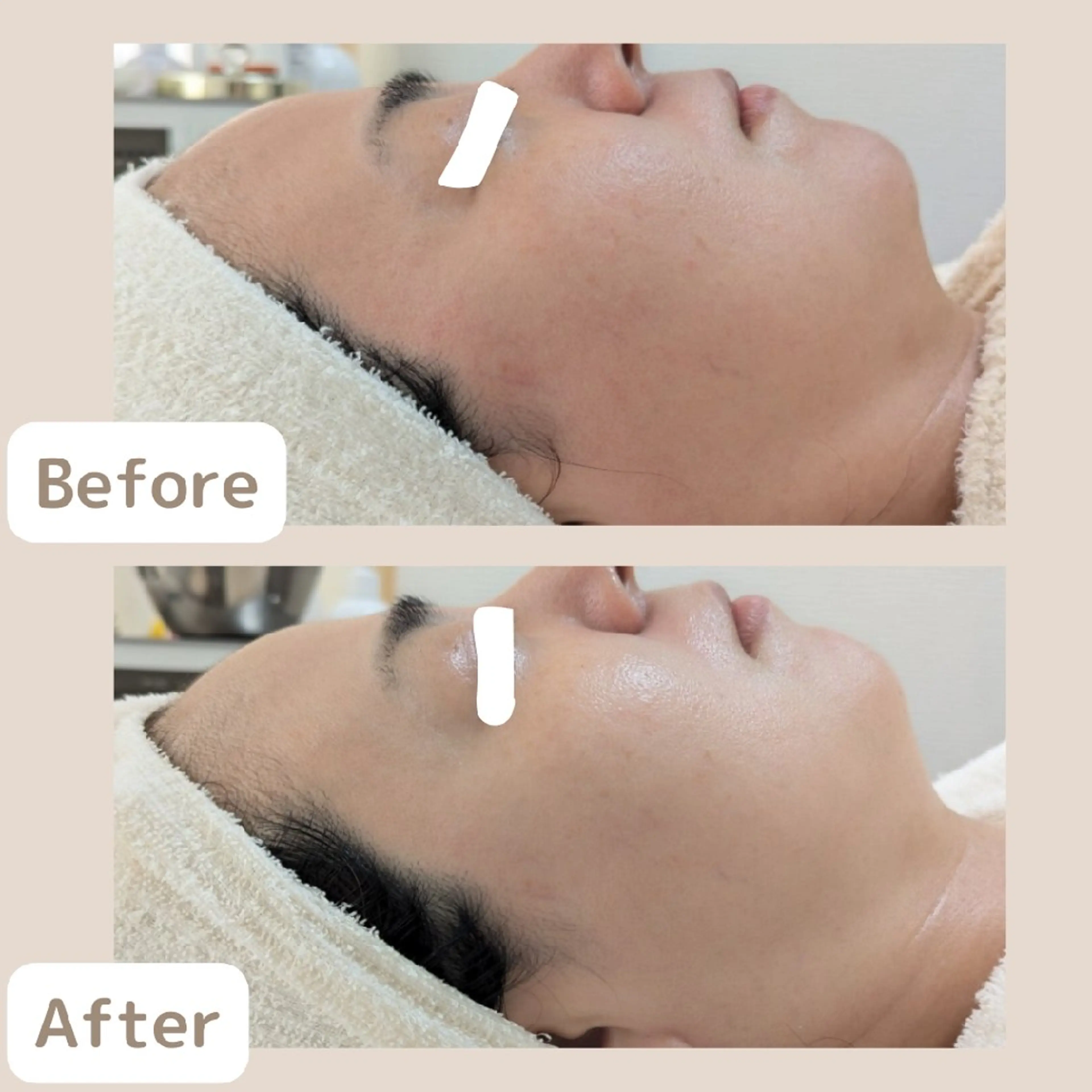 3ヶ月で−10歳肌✨《40歳以上の方に人気！透明感UP☆》くすみ改善＆シミケアコース2回体験 [大阪城北詰/京橋駅]の写真