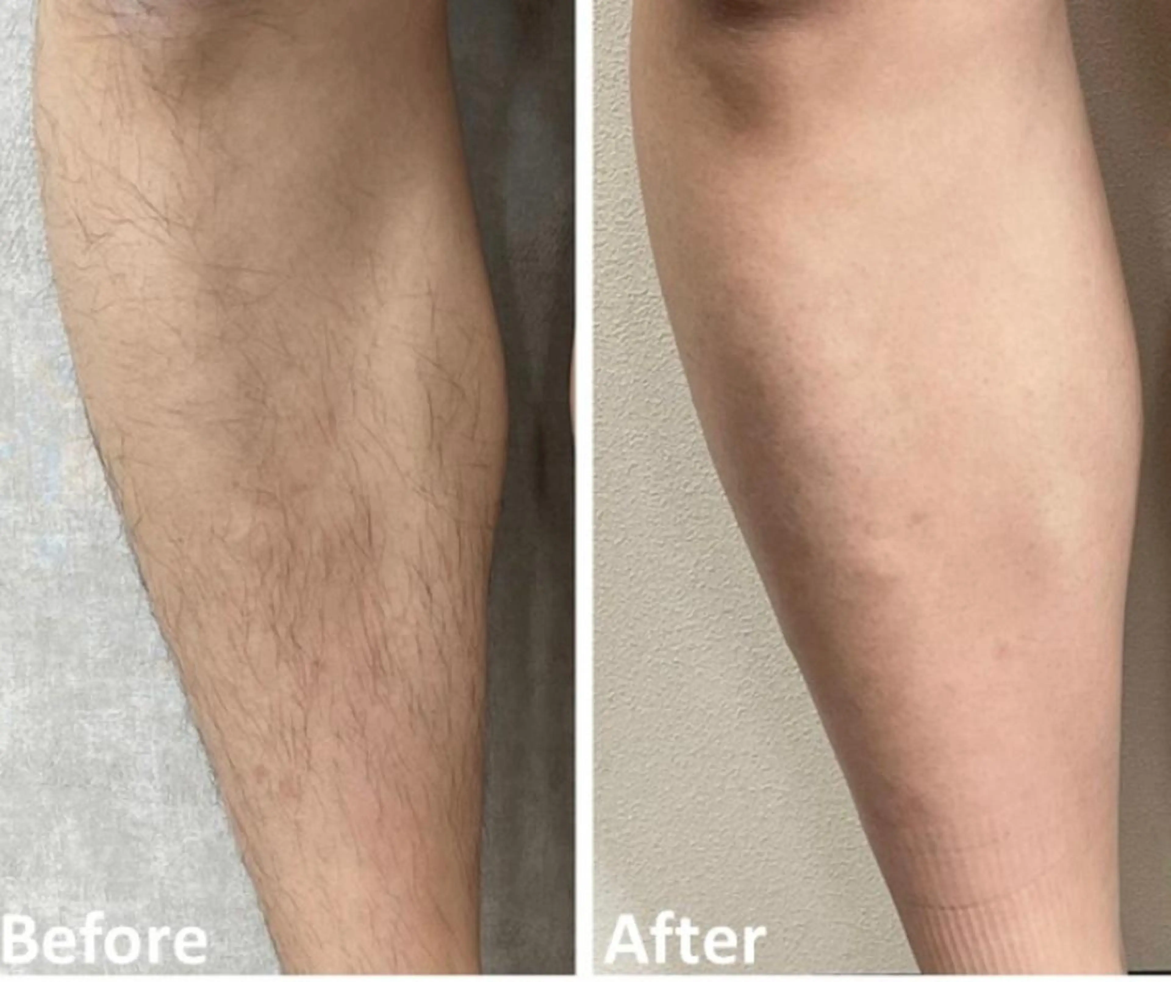 【美肌脱毛】足・足の甲（男性）の写真