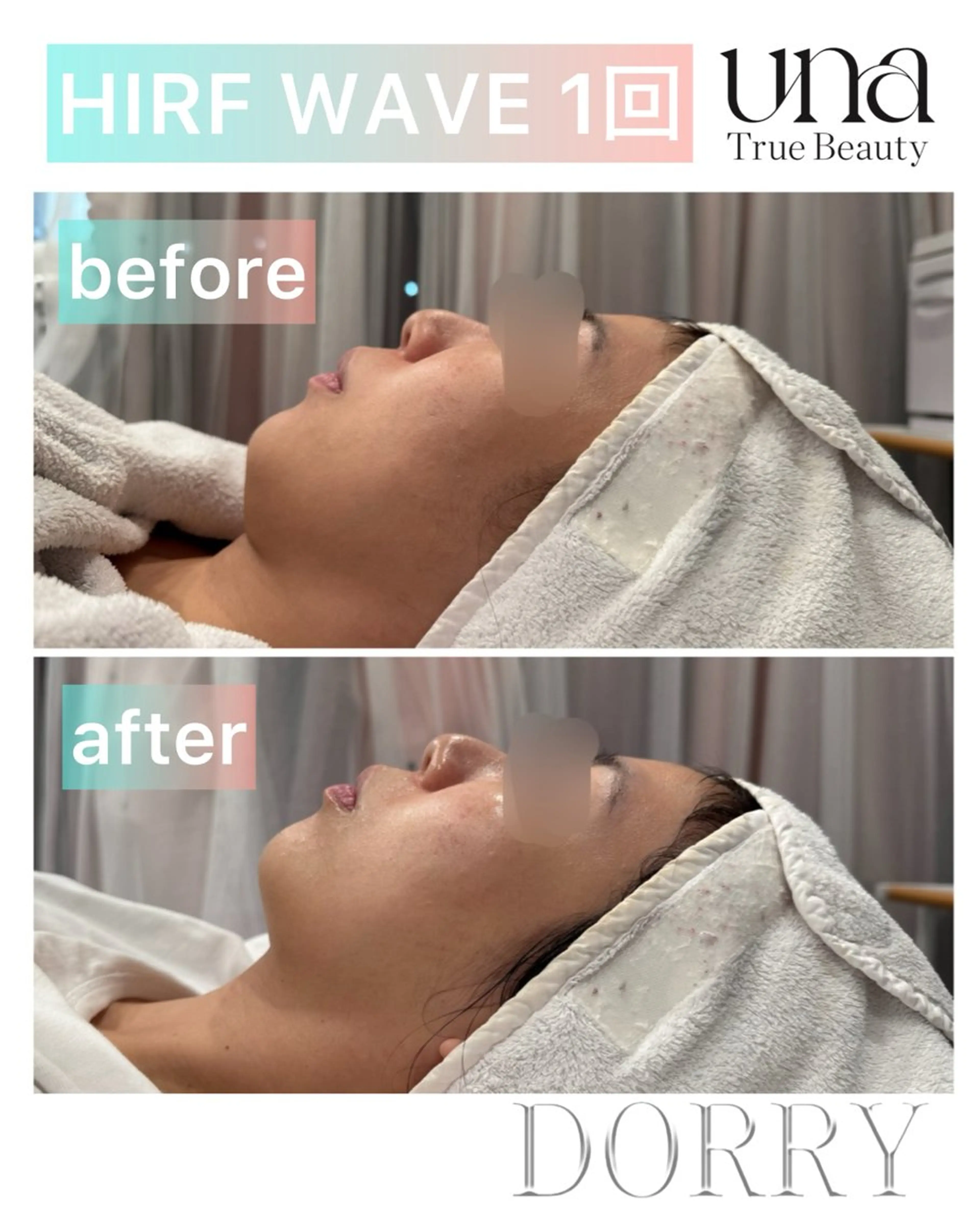 【初回限定】 HIRF WAVE（UNA版ソフウェーブ！）の写真