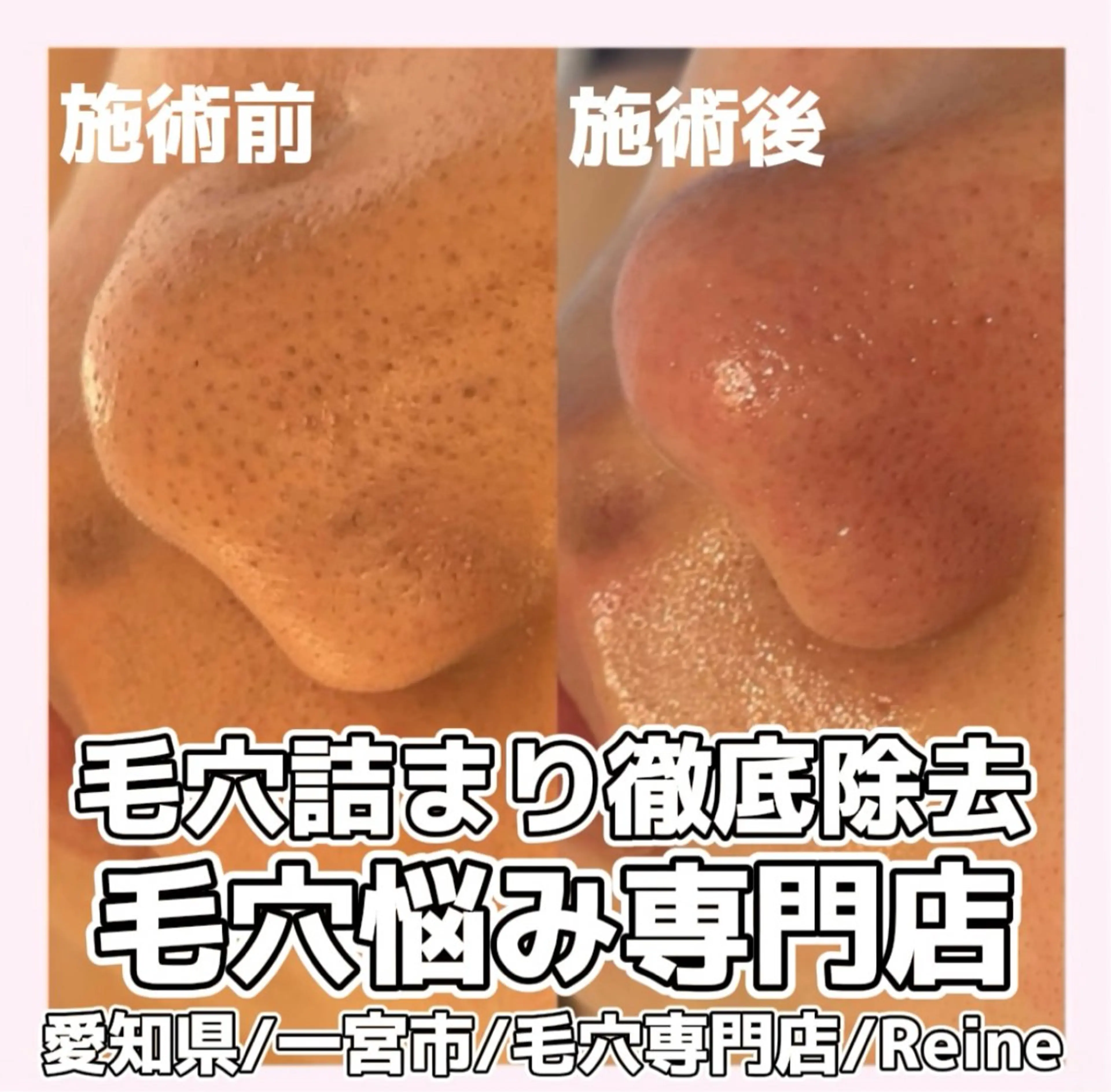 エステ Reine BeautySalon所属・毛穴/シミ肝斑/脱毛 横山梨里のエステ・リラクイメージ