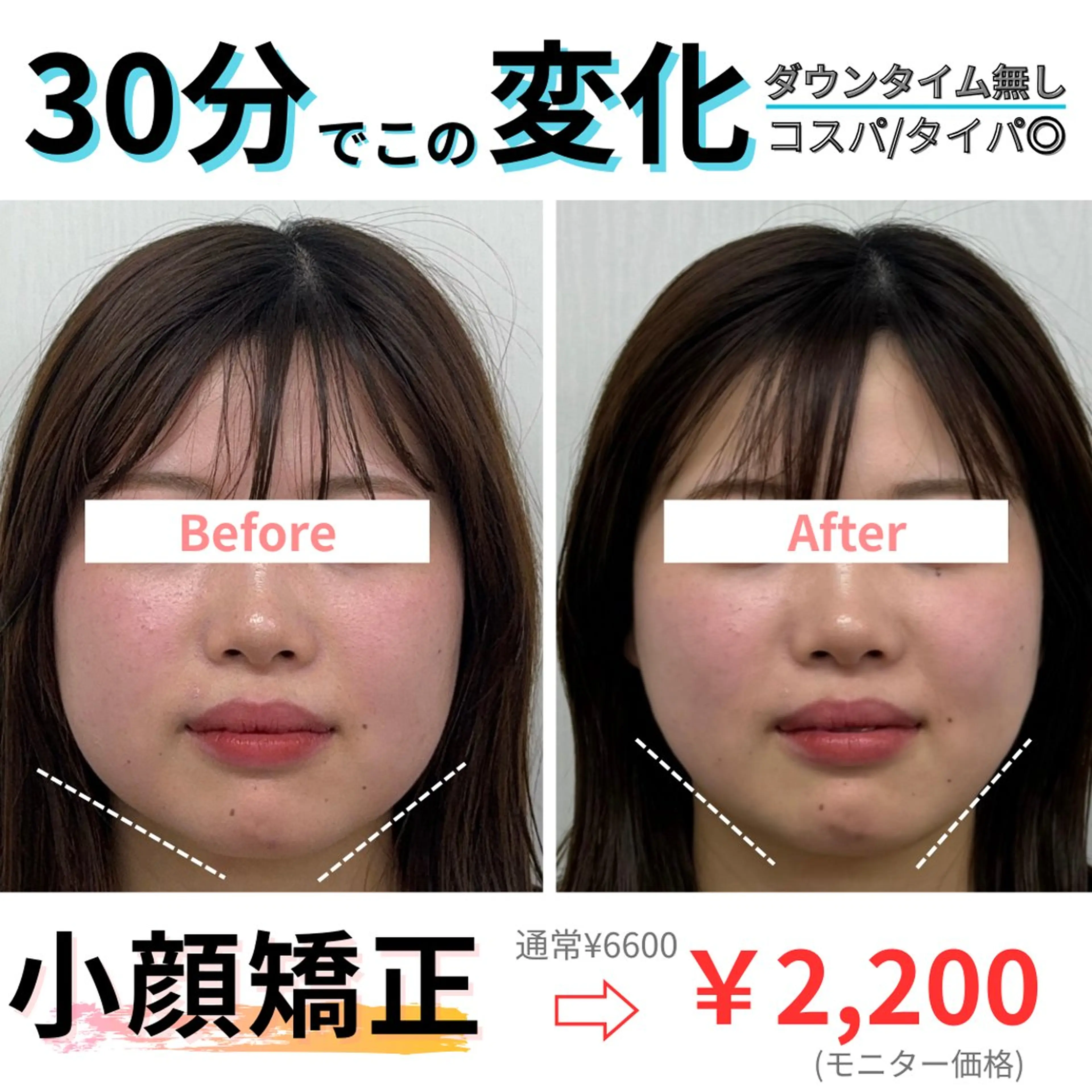 【🌟minimo限定🌟】小顔矯正6600→3300の写真