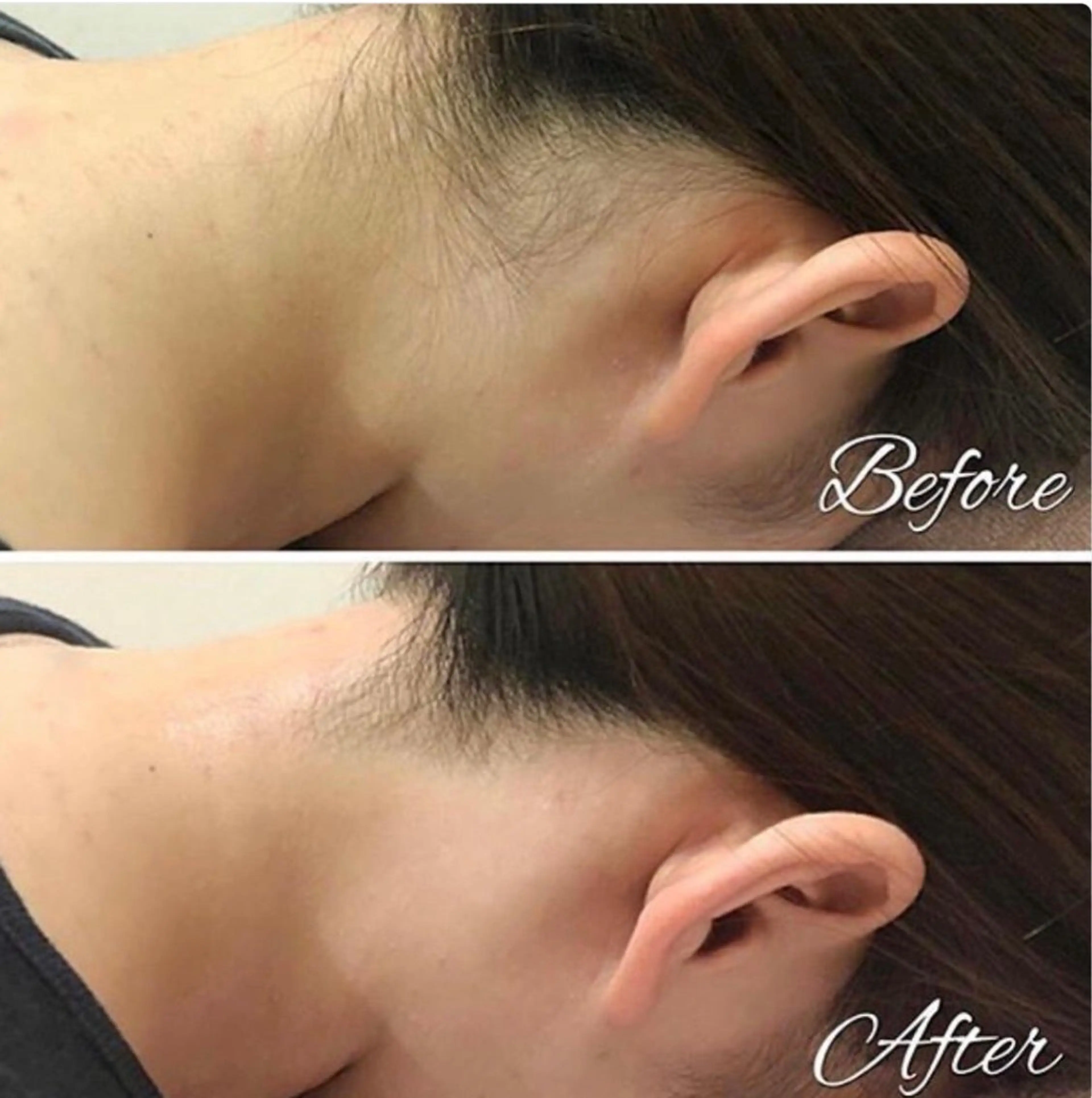 うなじ脱毛+デザインシェービング付¥2500《ポニーテールや前撮り◎》産毛対応✨の写真