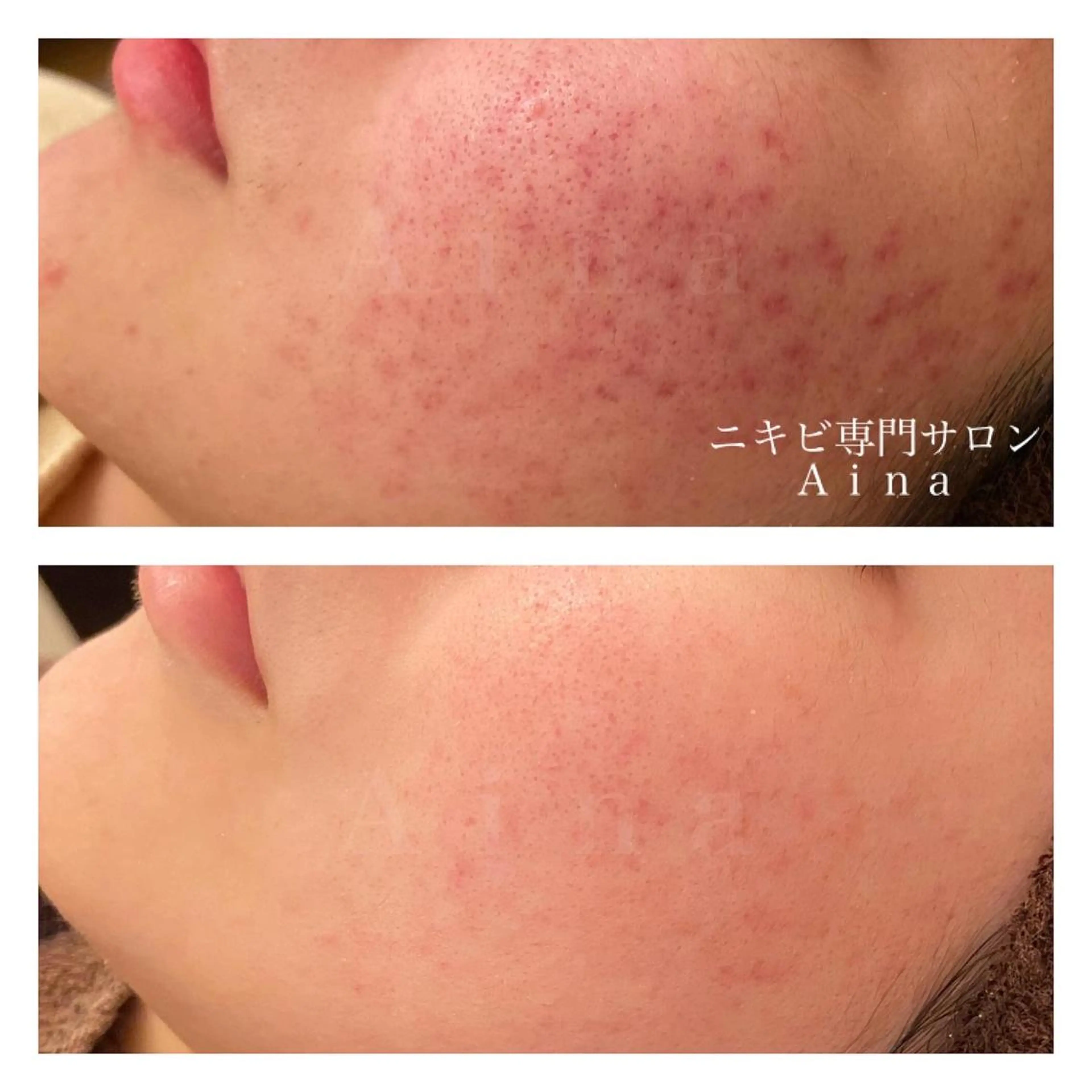 セミロング カラー パーマ ヘアアレンジ メンズ キッズ ネイル マツエク・マツパ 赤色 エステ リラク ニキビ跡専門サロン Ａｉｎａのエステ・リラクイメージ