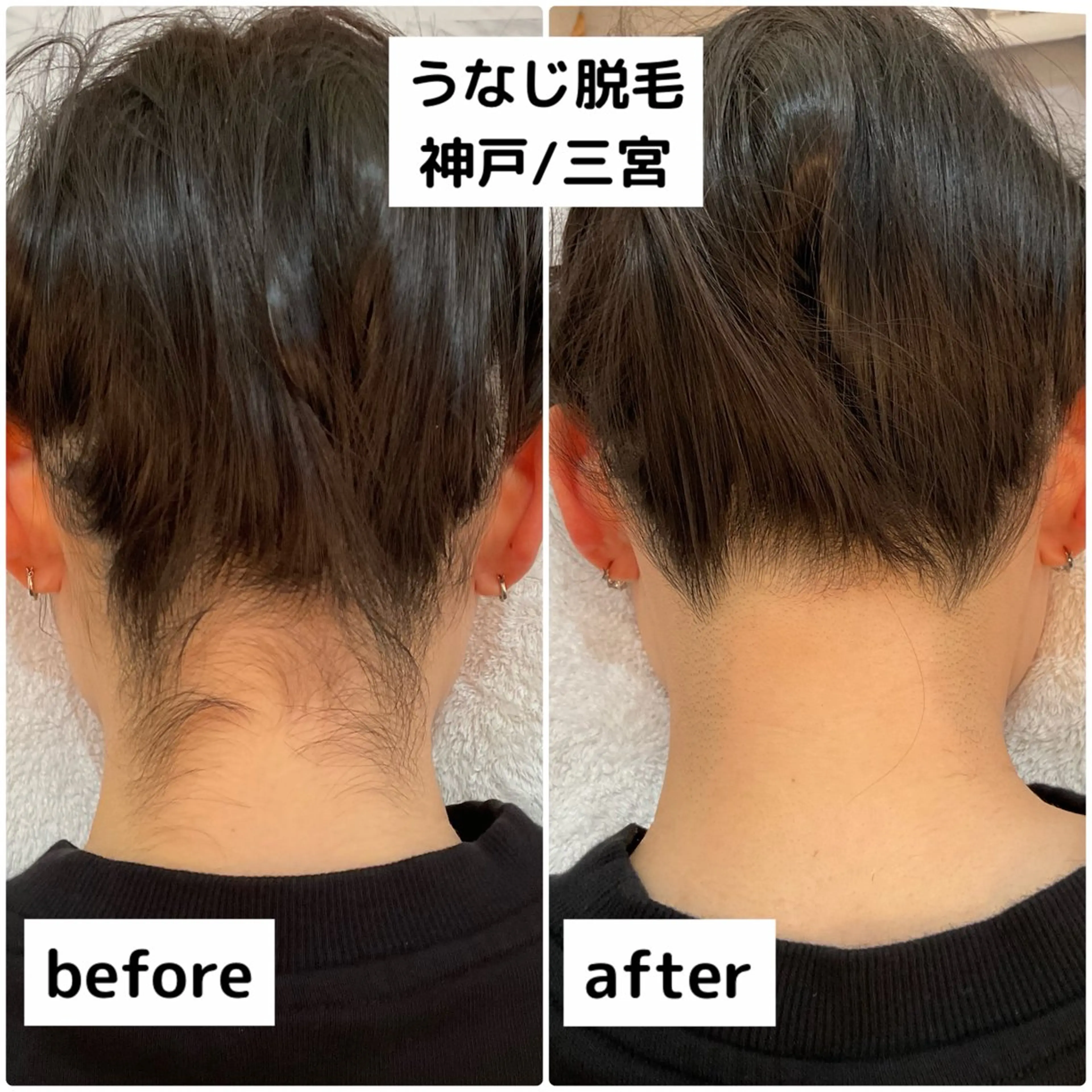 うなじ・襟足脱毛の写真