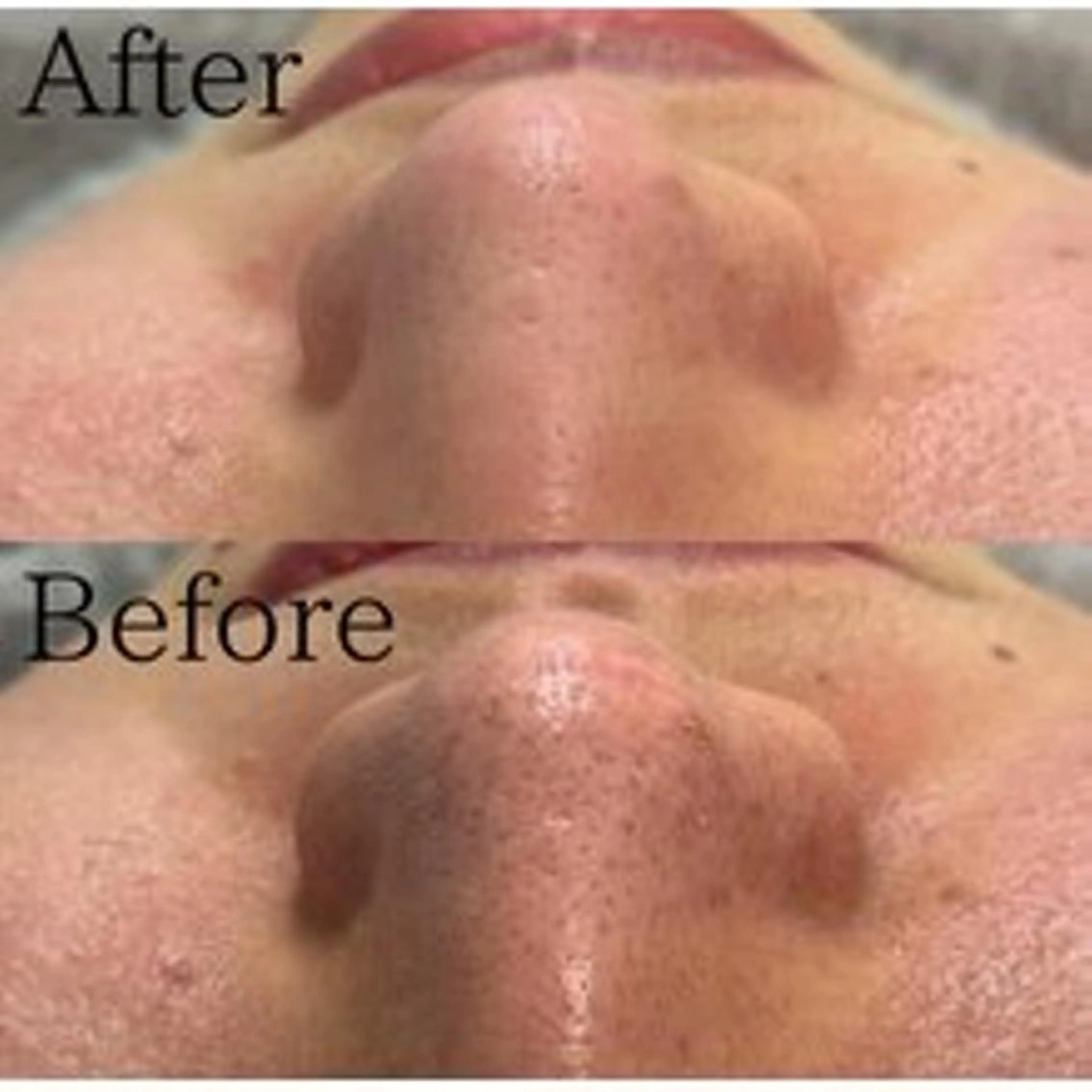 【毛穴洗浄】全顔♥の写真