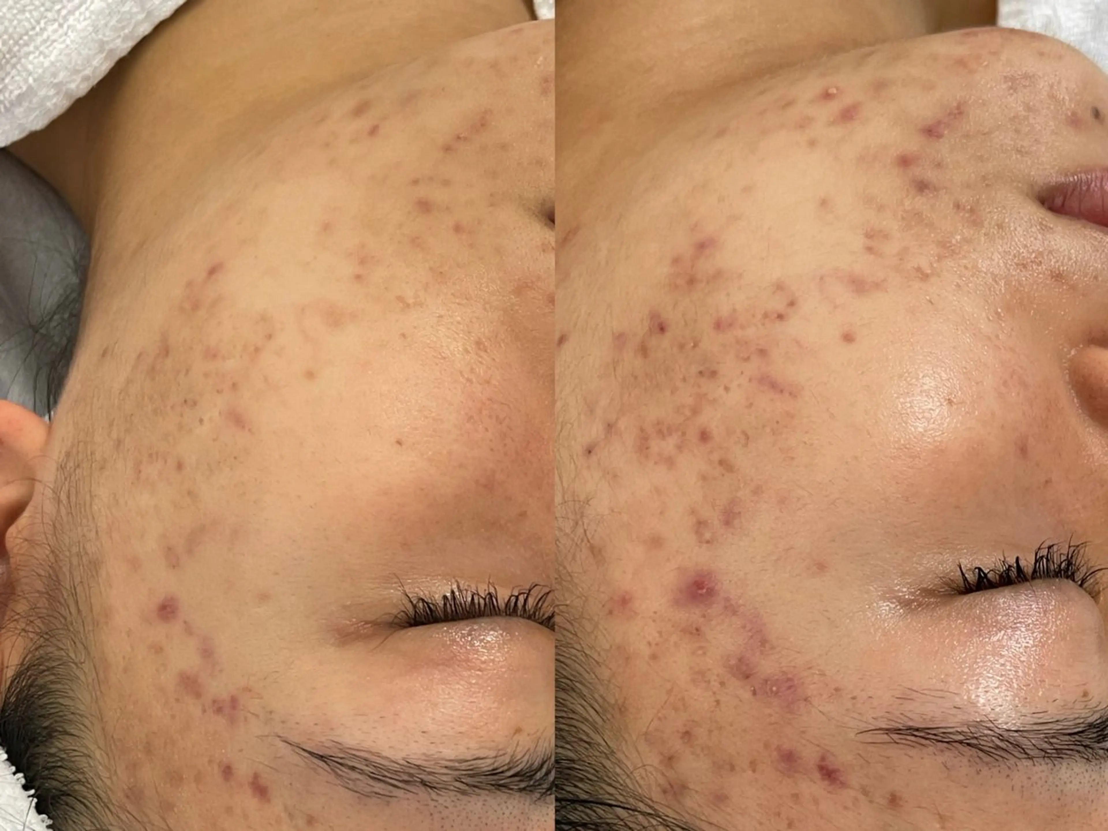 private salon éclat所属・ニキビ・毛穴専門 éclat/エクラのエステ・リラクイメージ