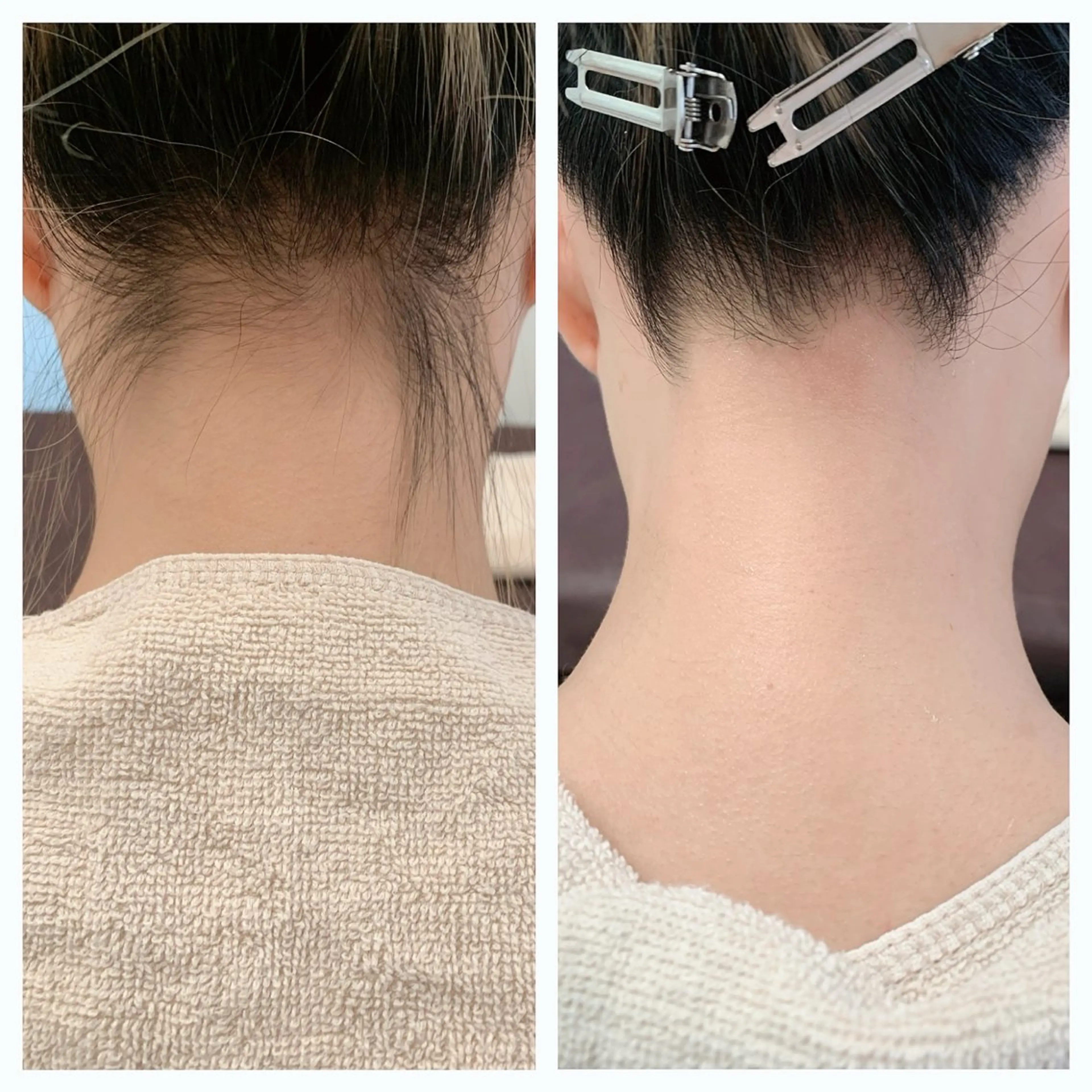 脱毛 meow by hug.所属・恵比寿🌻ワックス 顔うなじVIOワキのエステ・リラクイメージ