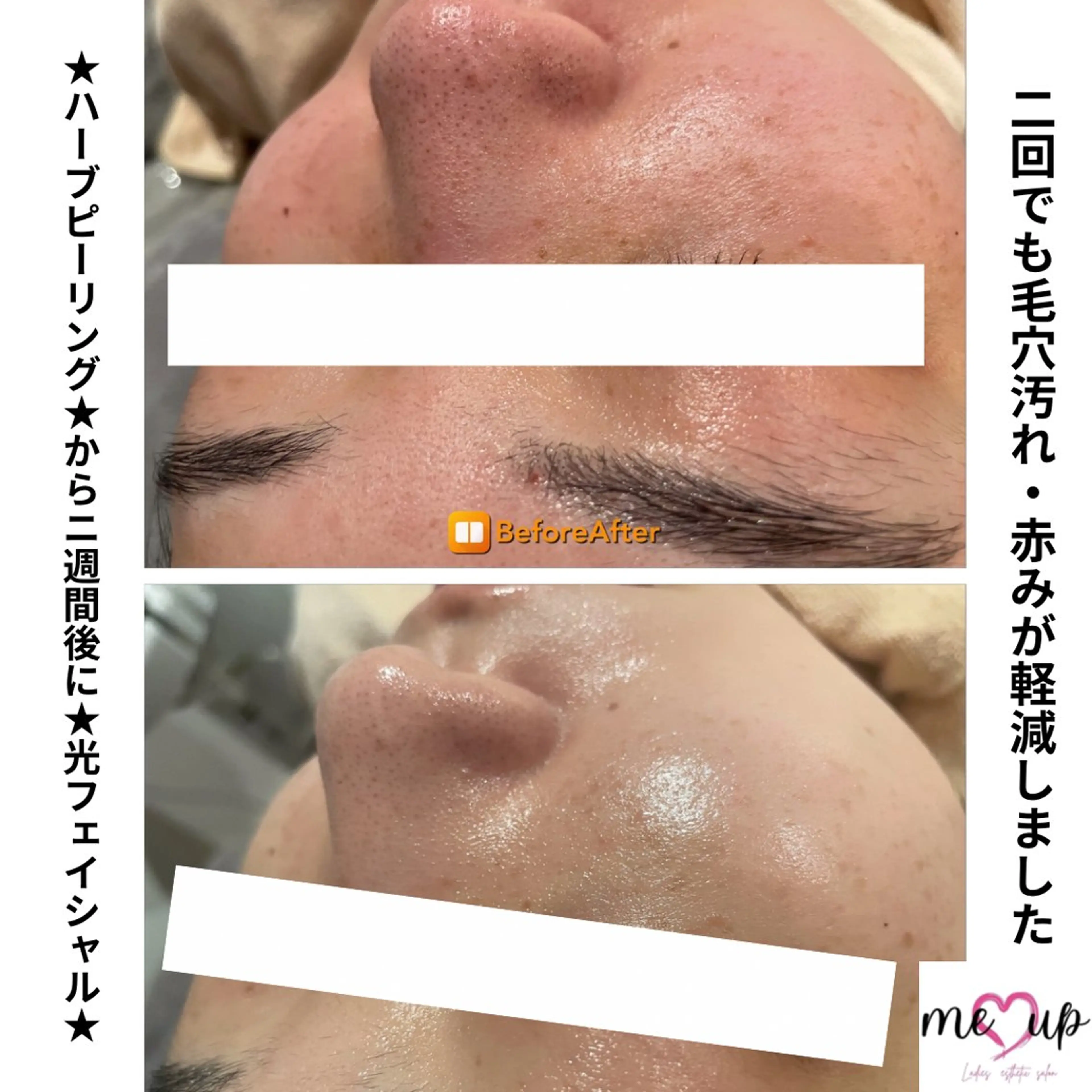 エステ Meupニキビ専門店 背中/ハーブ/肌管理のその他イメージ