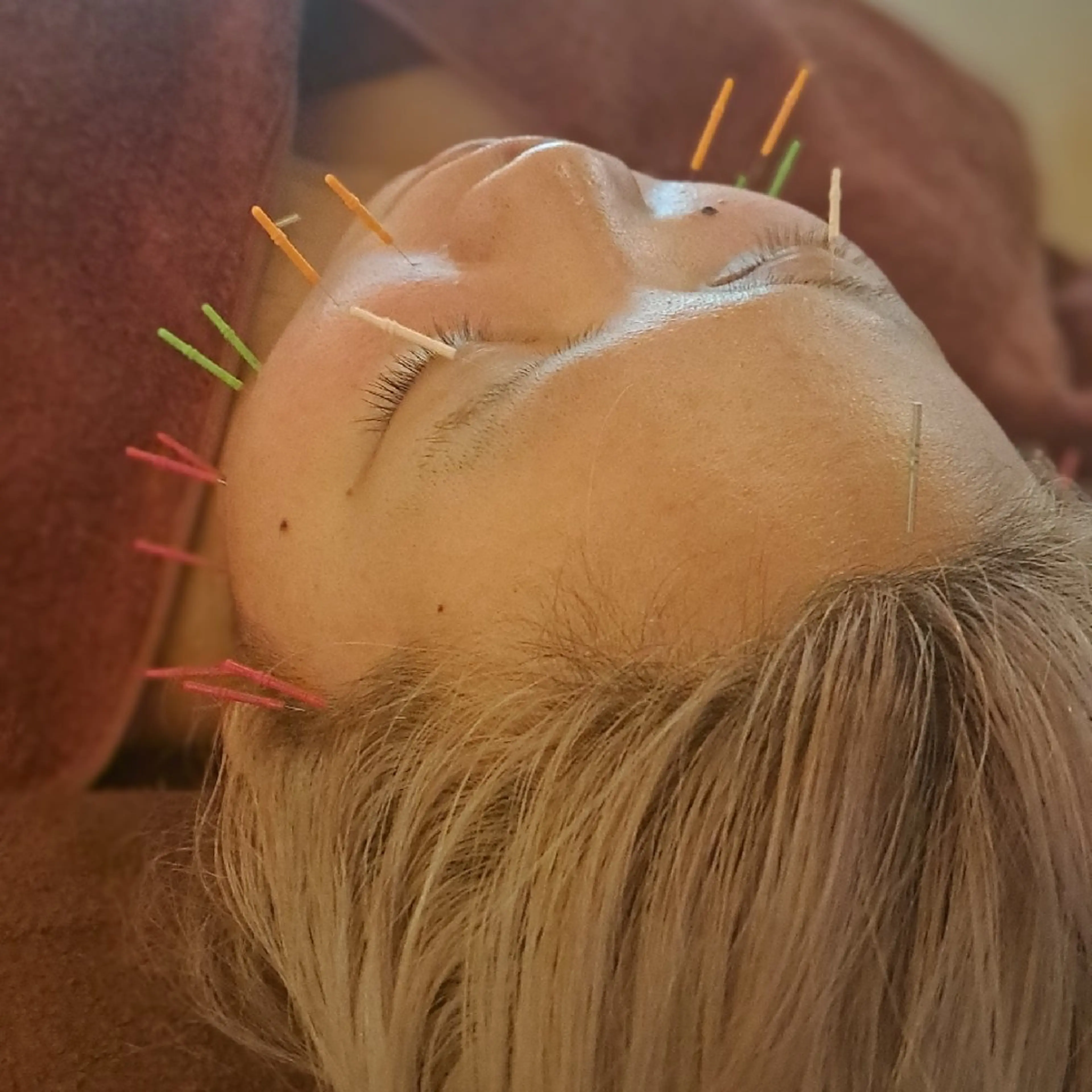 鍼灸サロンmiyabi所属・美容鍼×エステ 鍼灸 サロンmiyabiのエステ・リラクイメージ