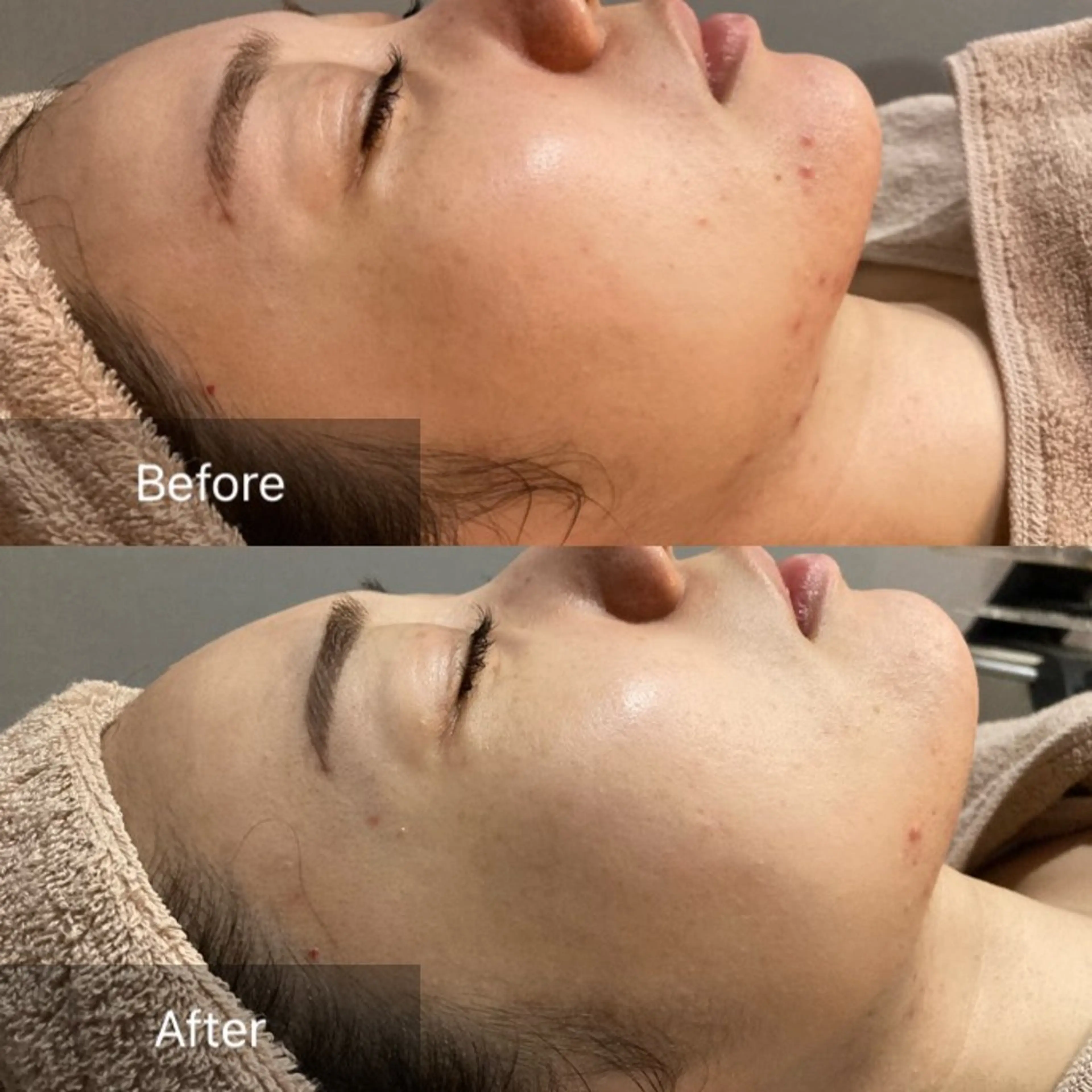 【ニキビのお悩みのある方限定】ハーブピーリングの写真