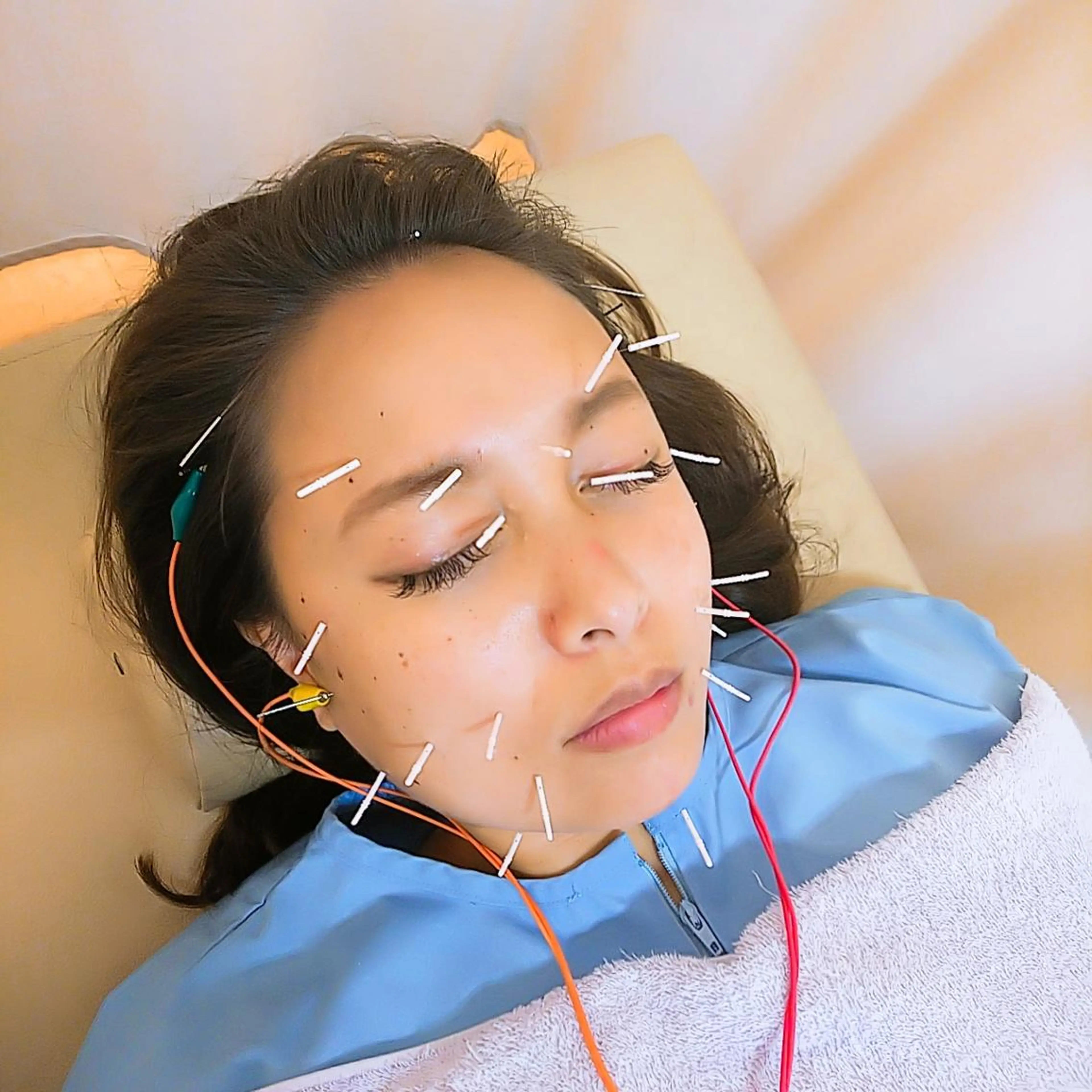 リフトアップ・たるみ ☆美容鍼小顔矯正のその他イメージ