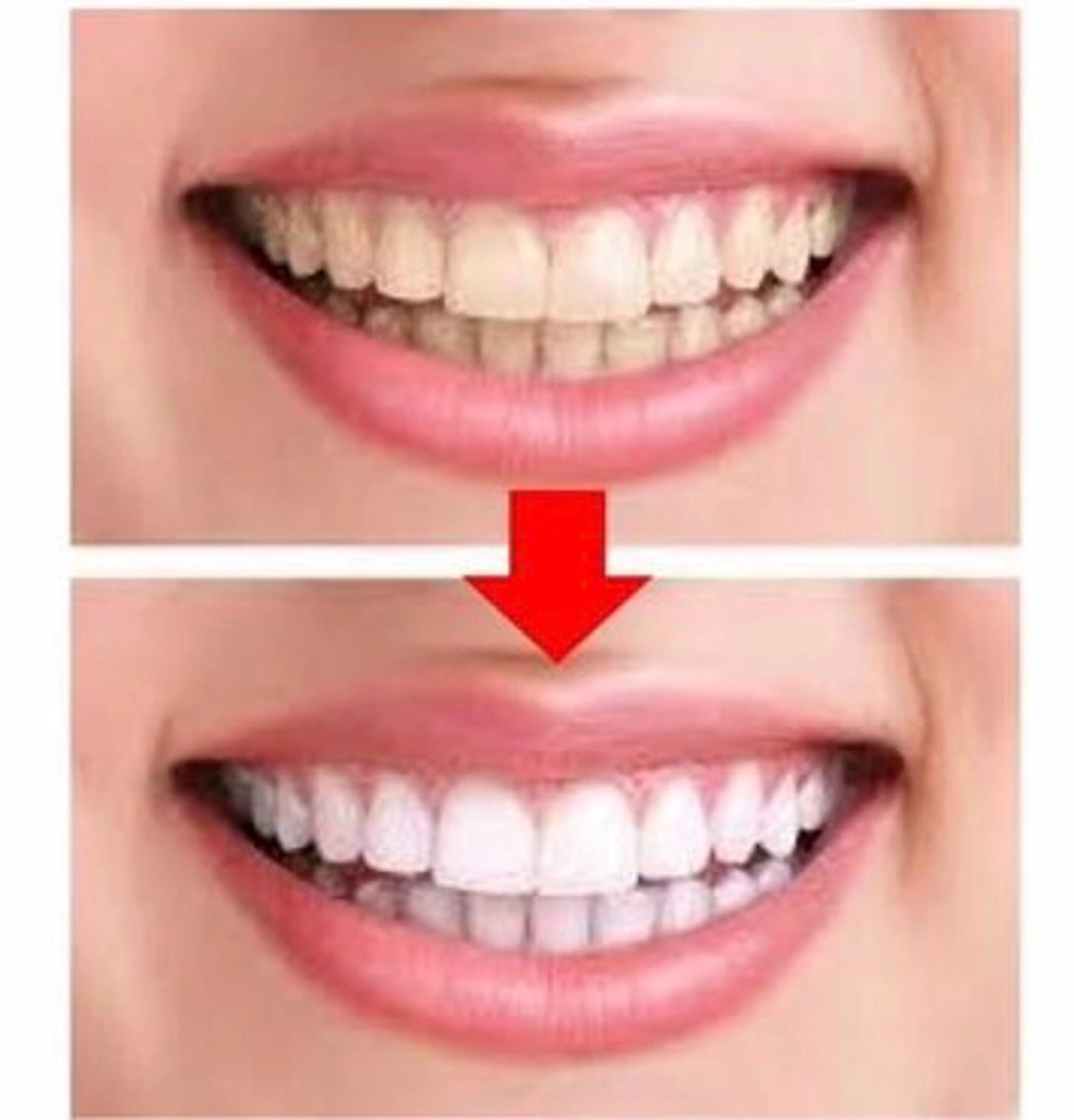 輝く白い歯で笑顔美人度UP✨セルフホワイトニング10分✖️4照射🦷✨歯がキレイになるだけでお顔のイメージは激変しますの写真